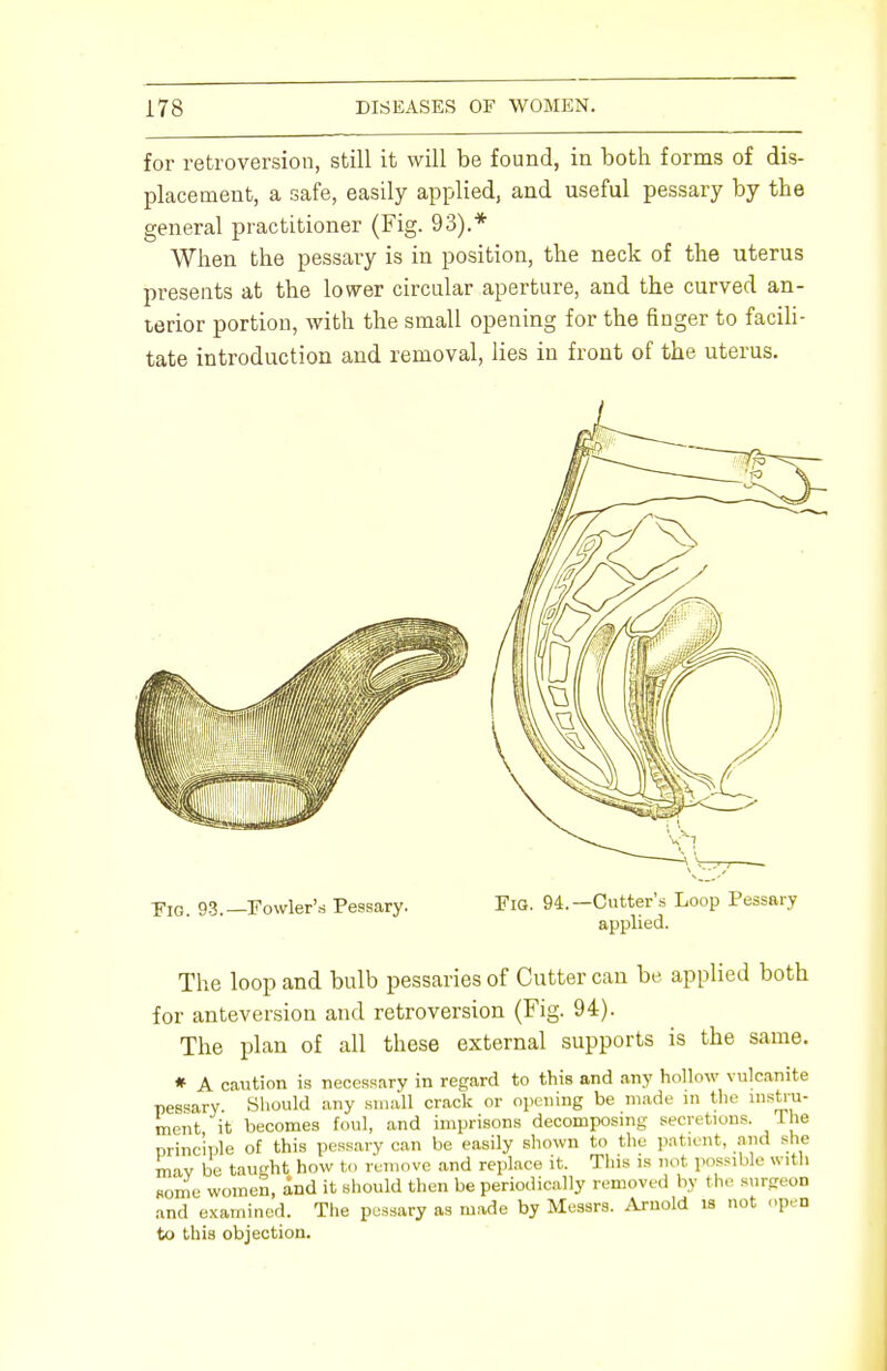 for retroversion, still it will be found, in both forms of dis- placement, a safe, easily applied, and useful pessary by the general practitioner (Fig. 93).* When the pessary is in position, the neck of the uterus presents at the lower circular aperture, and the curved an- terior portion, with the small opening for the finger to facili- tate introduction and removal, lies in front of the uterus. Fig. 93.—Fowler's Pessary. Fig. 94.—Cutter's Loop Pessary applied. The loop and bulb pessaries of Cutter can be applied both for anteversion and retroversion (Fig. 94). The plan of all these external supports is the same. * A caution is necessary in regard to this and any hollow vulcanite pessary Should any small crack or opening be made in the instru- ment it becomes foul, and imprisons decomposing secretions. The principle of this pessary can be easily shown to the patient, and she mav be taught how to remove and replace it. This is not possible with some women, and it should then be periodically removed by the surgeon and examined. The pessary as made by Messrs. Arnold is not open to this objection.