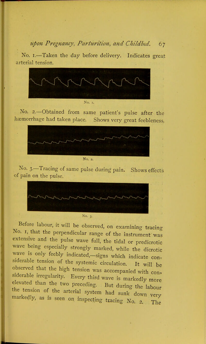 No. I.—Taken the day before delivery. Indicates great arterial tension. No. 2.—Obtained from same patient's pulse after the haemorrhage had taken place. Shows very great feebleness. No. 3.—Tracing of same pulse during pain. Shows efifects of pain on the pulse. No. 3. Before labour, it will be observed, on examining tracing No. I, that the perpendicular range of the instrument was extensive and the pulse wave full, the tidal or predicrotic wave bemg especially strongly marked, while the dicrotic wave is only feebly indicated,-signs which indicate con- siderable tension of the systemic circulation. It will be observed that the high tension was accompanied with con, siderable irregularity. Every third wave is markedly more elevated than the two preceding. But during the labour the tension of the arterial system had sunk down very markedly, as is seen on inspecting tracing No 2 The