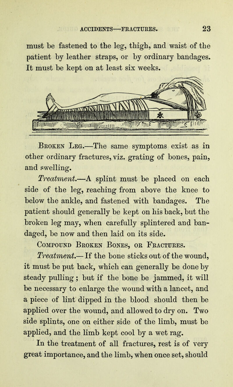 must be fastened to the leg-, thigh, and waist of the patient by leather straps, or by ordinary bandages. It must be kept on at least six weeks. Broken Leg.—The same symptoms exist as in other ordinary fractures, viz. grating of bones, pain, and swelling. Treatment.—A splint must be placed on each side of the leg, reaching from above the knee to below the ankle, and fastened with bandages. The patient should generally be kept on his back, but the broken leg may, when carefully splintered and ban- daged, be now and then laid on its side. Compound Bkoken Bones, or Fractures. Treatment.— If the bone sticks out of the wound, it must be put back, which can generally be done by steady pulling ; but if the bone be jammed, it will be necessary to enlarge the wound with a lancet, and a piece of lint dipped in the blood should then be applied over the wound, and allowed to dry on. Two side splints, one on either side of the limb, must be applied, and the limb kept cool by a wet rag. In the treatment of all fractures, rest is of very great importance, and the limb, when once set, should