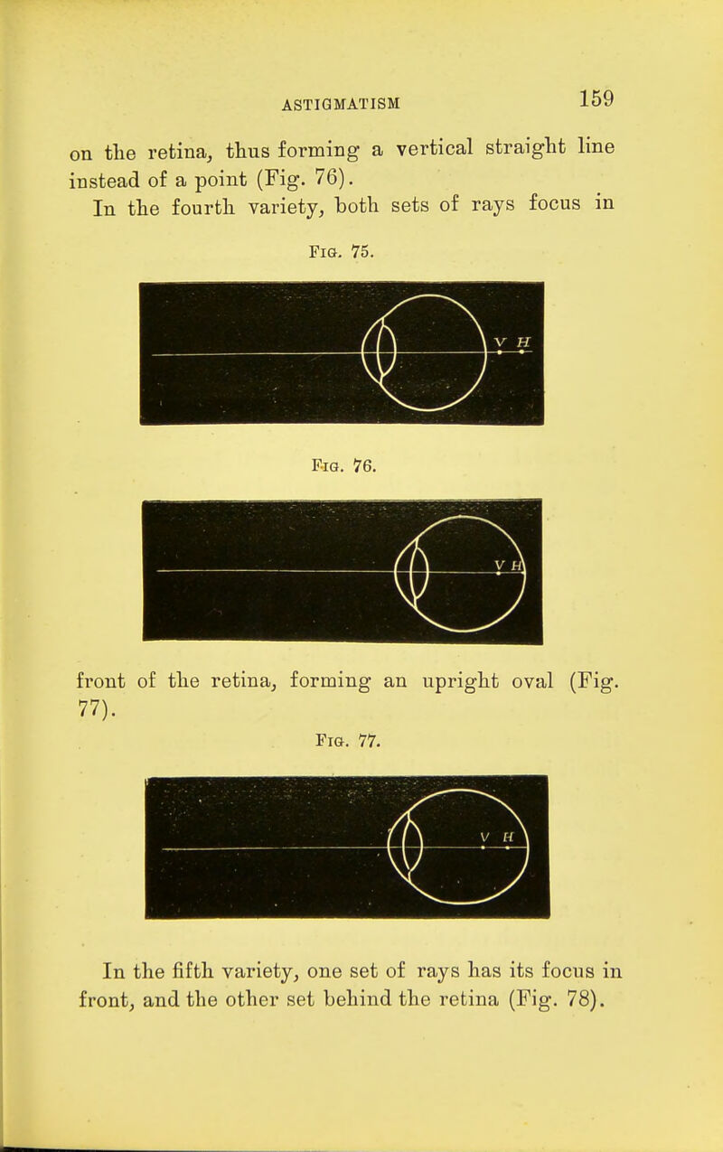 on the retina, thus forming a vertical straight line instead of a point (Fig. 76). In the fourth variety, both sets of rays focus in Fig. 75. front of the retina, forming an upright oval (Fig. 77). Fig. 77. In the fifth variety, one set of rays has its focus in front, and the other set behind the retina (Fig. 78).