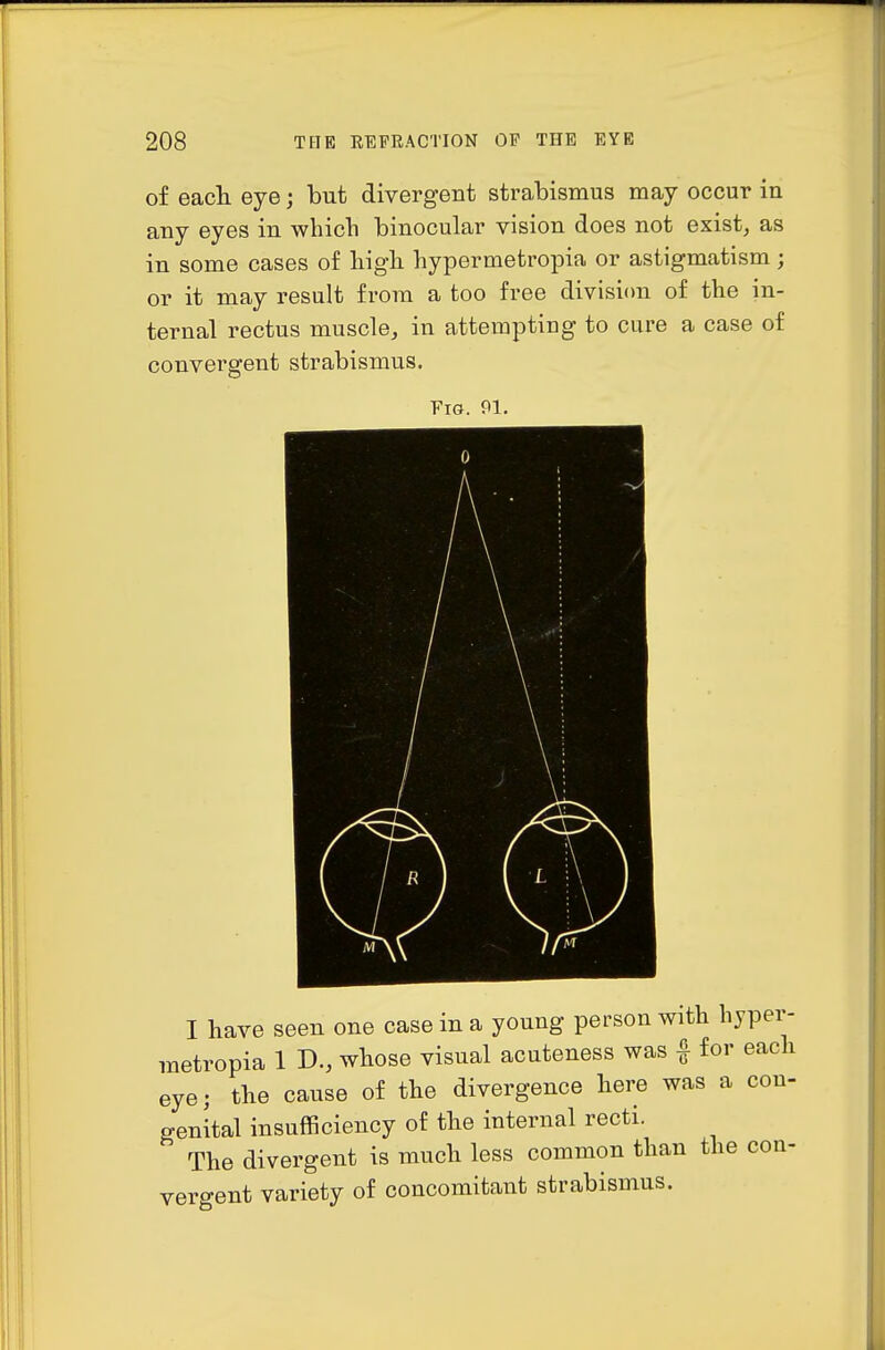 of eacli eye; but divergent strabismus may occur in any eyes in which binocular vision does not exist, as in some cases of high hypermetropia or astigmatism; or it may result from a too free divisi(m of the in- ternal rectus muscle, in attempting to cure a case of convergent strabismus. Fig. 91. I have seen one case in a young person with hypei- raetropia 1 B., whose visual acuteness was f for each eye; tlie cause of the divergence here was a con- genital insufficiency of the internal recti. The divergent is much less common than the con- vergent variety of concomitant strabismus.