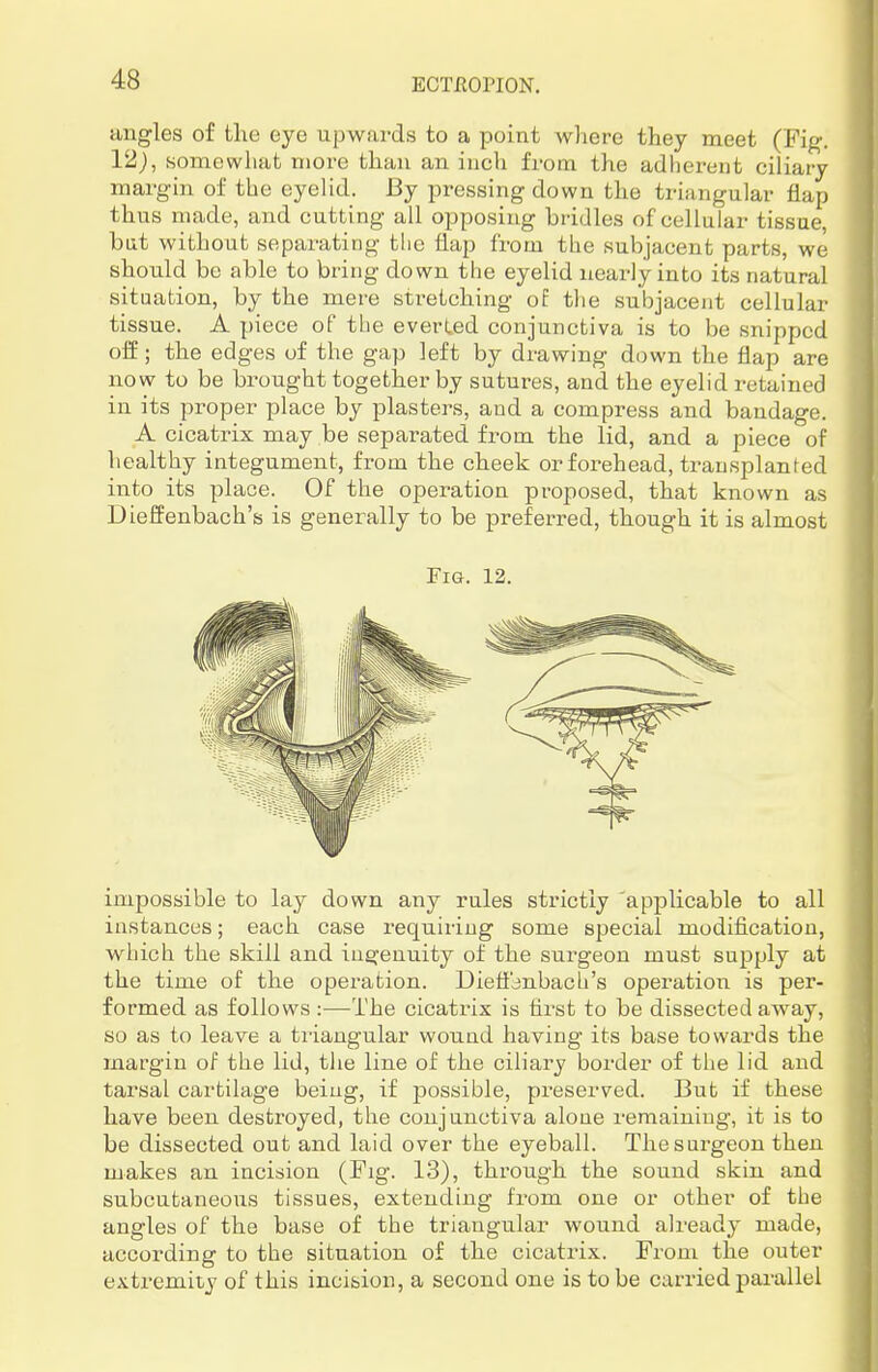 angles of the eye upwards to a point where they meet (Fig. 12), somewhat more than an inch from the adherent ciliary margin of the eyelid. By pressing down the triangular flap thus made, and cutting all opposing bridles of cellular tissue, but without separating the flap from the subjacent parts, we should be able to bring down the eyelid nearly into its natural situation, by the mere stretching of the subjacent cellular tissue. A piece of the everted conjunctiva is to be snipped off; the edges of the gap left by drawing down the flap are now to be brought together by sutm-es, and the eyelid retained in its proper place by plasters, and a compress and bandage. A cicatrix may be separated from the lid, and a piece of healthy integument, from the cheek or forehead, transplanted into its place. Of the operation proposed, that known as Dieffenbach's is generally to be preferred, though it is almost Fig. 12. impossible to lay down any rules strictly applicable to all instances; each case requiring some special modification, which the skill and ingenuity of the surgeon must supply at the time of the operation. Dieflknbach's operation is per- formed as follows :—The cicatrix is first to be dissected away, so as to leave a triangular wound having its base towards the margin of the lid, the line of the ciliary border of the lid and tarsal cartilage being, if possible, preserved. But if these have been destroyed, the conjunctiva alone remaining, it is to be dissected out and laid over the eyeball. The surgeon then makes an incision (Fig-. 13), through the sound skin and subcutaneous tissues, extending from one or other of the angles of the base of the triangular wound already made, according to the situation of the cicatrix. From the outer extremity of this incision, a second one is to be carried parallel