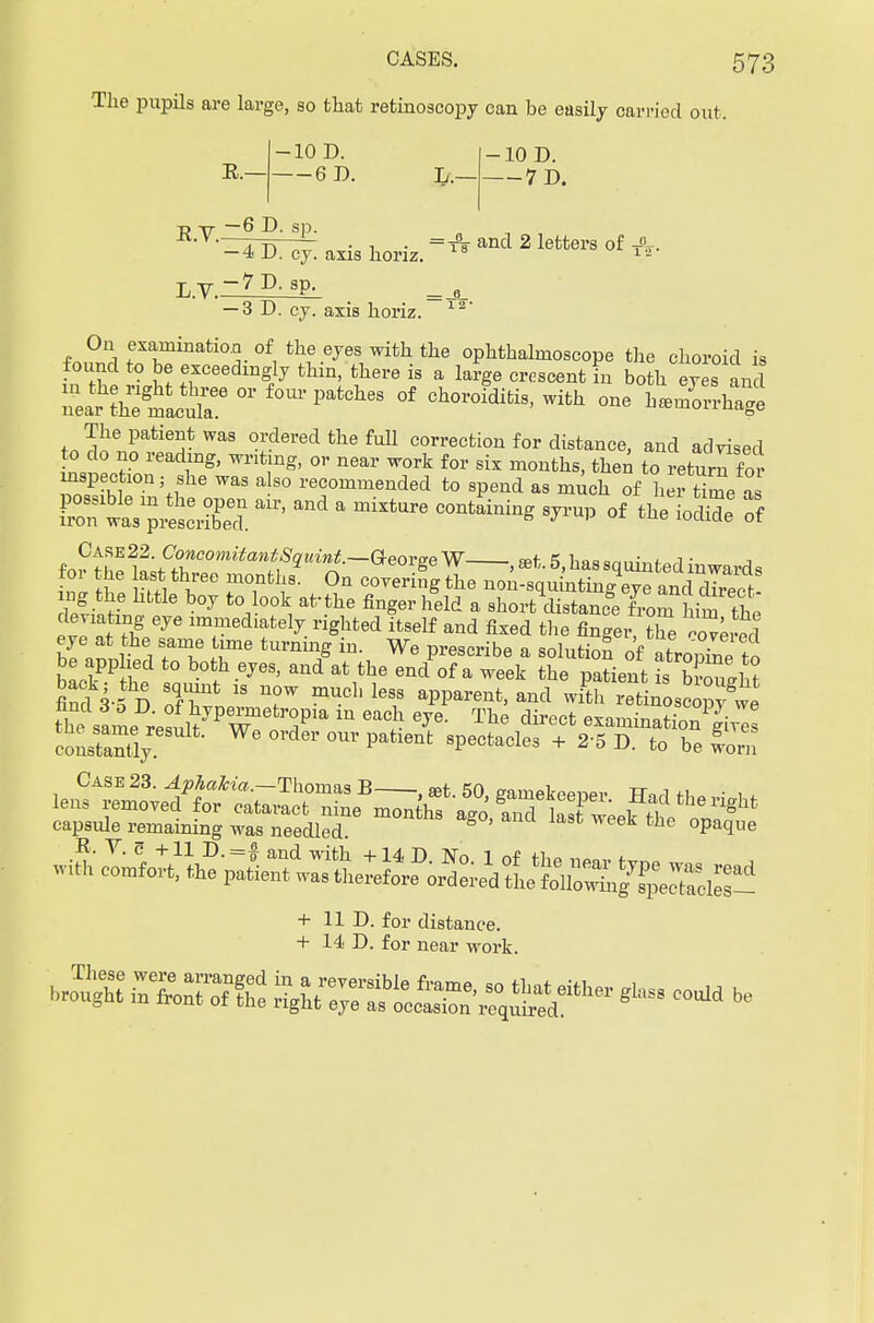 The pupils are large, so that retinoscopy can be easily carried out. E.— -10 D. 6D. Tf.- -10 D. 7 D. ■p T7- —6 D. sp. dTrTlb ■ ^ ■ =A and 2 letters of A. — 4 L>. cy. axis lioriz. 12 T.y -?P- sp. — 3 D. cy. axis horiz. 12' On examination of the eyes with the ophthalmoscope the choroid is found to be exceedingly thin, there is a large crescent in both era and The patient was ordered the full correction for distance, and advised £, P,f°.re ^ Writ.mg' °r near W°rk f°r Sk months> tte° to retura for mspection; she was also recommended to spend as much of her time as ETwas prtrE ^ ^ a miXtUre C0Qtain^ S^ of the ioS 3 ^tS.hassquintedinwards fl! S if moiiti;8- On covering the non-squinting eye and direct- ing the hitle boy to look af the finger held a short distance from him tt deviating eye immediately righted itself and fixed the finger, the 4™ed eye at the same time turning in. We prescribe a solution of atroS to be applied to both eyes, and at the end of a week the paLnt ibvZlt k',^ 13 U0W mUcL less aPParent' ^d with^ retinosconvte the^ame resul^Pwmefcr,°Pia * ^ ^ direcfc amSS^ir^ consSr Pa ^ SpeCtaCleS + 2'5 D- t0 be c™ capsule remaining was needled the °Paq-ue + 11 D. for distance. + 14 D. for near work.