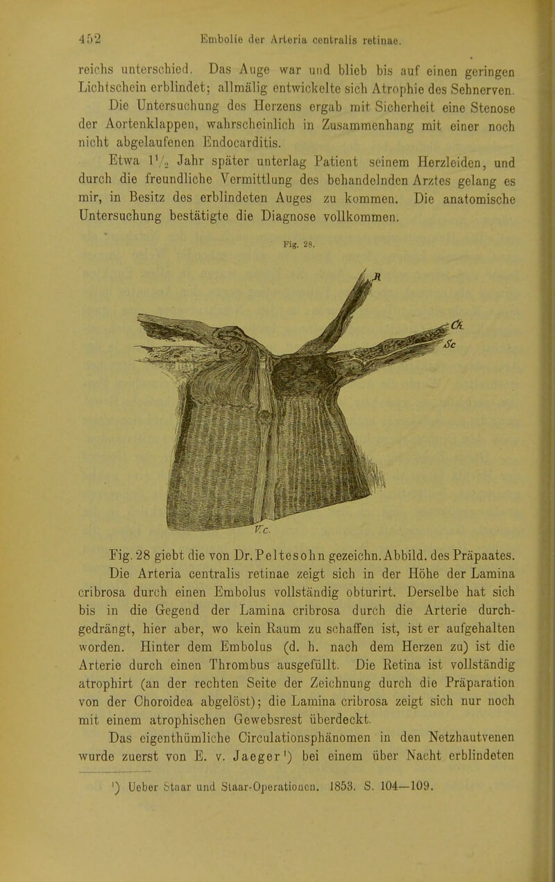 reichs unterschied. Das Auge war und blieb bis auf einen geringen Lichtschein erblindet; allmälig entwickelte sich Atrophie des Sehnerven. Die Untersuchung dos Herzens ergab mit Sicherheit eine Stenose der Aortenklappen, wahrscheinlich in Zusammenhang mit einer noch nicht abgelaufenen Endocarditis. Etwa l.1/2 Jahr später unterlag Patient seinem Herzleiden, und durch die freundliche Vermittlung des behandelnden Arztes gelang es mir, in Besitz des erblindeten Auges zu kommen. Die anatomische Untersuchung bestätigte die Diagnose vollkommen. ' Fig. 28. Fig. 28 giebt die von Dr.Peltesohn gezeichn.Abbild, des Präpaates. Die Arteria centralis retinae zeigt sich in der Höhe der Lamina cribrosa durch einen Embolus vollständig obturirt. Derselbe hat sich bis in die Gegend der Lamina cribrosa durch die Arterie durch- gedrängt, hier aber, wo kein Raum zu schaffen ist, ist er aufgehalten worden. Hinter dem Embolus (d. h. nach dem Herzen zu) ist die Arterie durch einen Thrombus ausgefüllt. Die Retina ist vollständig atrophirt (an der rechten Seite der Zeichnung durch die Präparation von der Choroidea abgelöst); die Lamina cribrosa zeigt sich nur noch mit einem atrophischen Gewebsrest überdeckt. Das eigenthümliche Circulationsphänomen in den Netzhautvenen wurde zuerst von E. v. Jaeger1) bei einem über Nacht erblindeten ') Ueber Staar und Staar-Operationcn. 1853. S. 104—109.