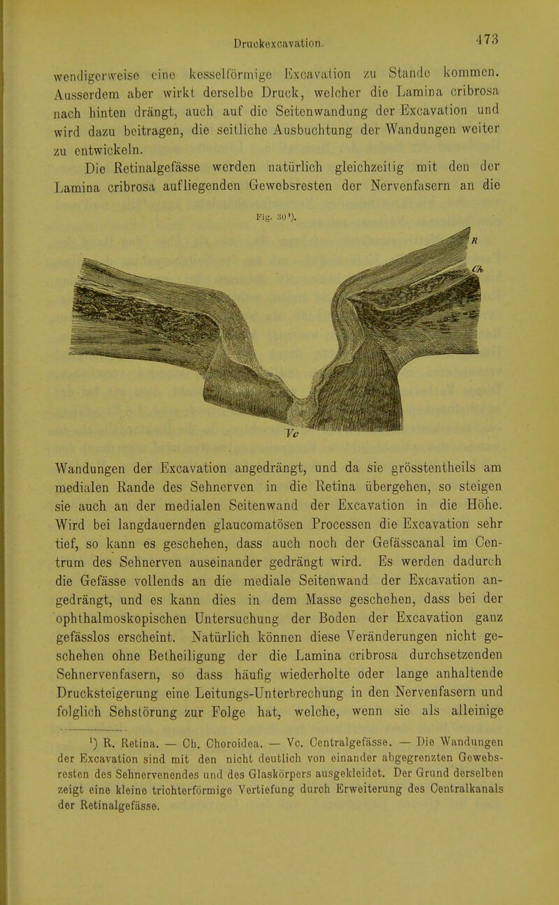 wendigerweise eine kesseiförmige Excavation zu Stande kommen. Ausserdem aber wirkt derselbe Druck, welcher die Lamina cribrosa nach hinten drängt, auch auf die Seitenwandung der Excavation und wird dazu beitragen, die seitliche Ausbuchtung der Wandungen weiter zu entwickeln. Die Retinalge fasse werden natürlich gleichzeitig mit den der Lamina cribrosa aufliegenden Gewebsresten der Nervenfasern an die Fig. 30 '). Wandungen der Excavation angedrängt, und da sie grösstentheils am medialen Rande des Sehnerven in die Retina übergehen, so steigen sie auch an der medialen Seitenwand der Excavation in die Höhe. Wird bei langdauernden glaueomatösen Processen die Excavation sehr tief, so kann es geschehen, dass auch noch der Gefässcanal im Cen- trum des Sehnerven auseinander gedrängt wird. Es werden dadurch die Gefässe vollends an die mediale Seitenwand der Excavation an- gedrängt, und es kann dies in dem Masse geschehen, dass bei der ophthalmoskopischen Untersuchung der Boden der Excavation ganz gefässlos erscheint. Natürlich können diese Veränderungen nicht ge- schehen ohne Betheiligung der die Lamina cribrosa durchsetzenden Sehnervenfasern, so dass häufig wiederholte oder lange anhaltende Drucksteigerung eine Leitungs-Unterbrechung in den Nervenfasern und folglich Sehstörung zur Folge hat, welche, wenn sie als alleinige ') R. Retina. — Cu. Choroidoa. — Vc. Centralgefasse. — Die Wandungen der Excavation sind mit den nicht deutlich von einander abgegrenzten Gewebs- resten des Sehncrvcnondes und des Glaskörpers ausgekleidet. Der Grund derselben zeigt eine kleine trichterförmige Vertiefung durch Erweiterung des Oentralkanals der Retinalgefässe.