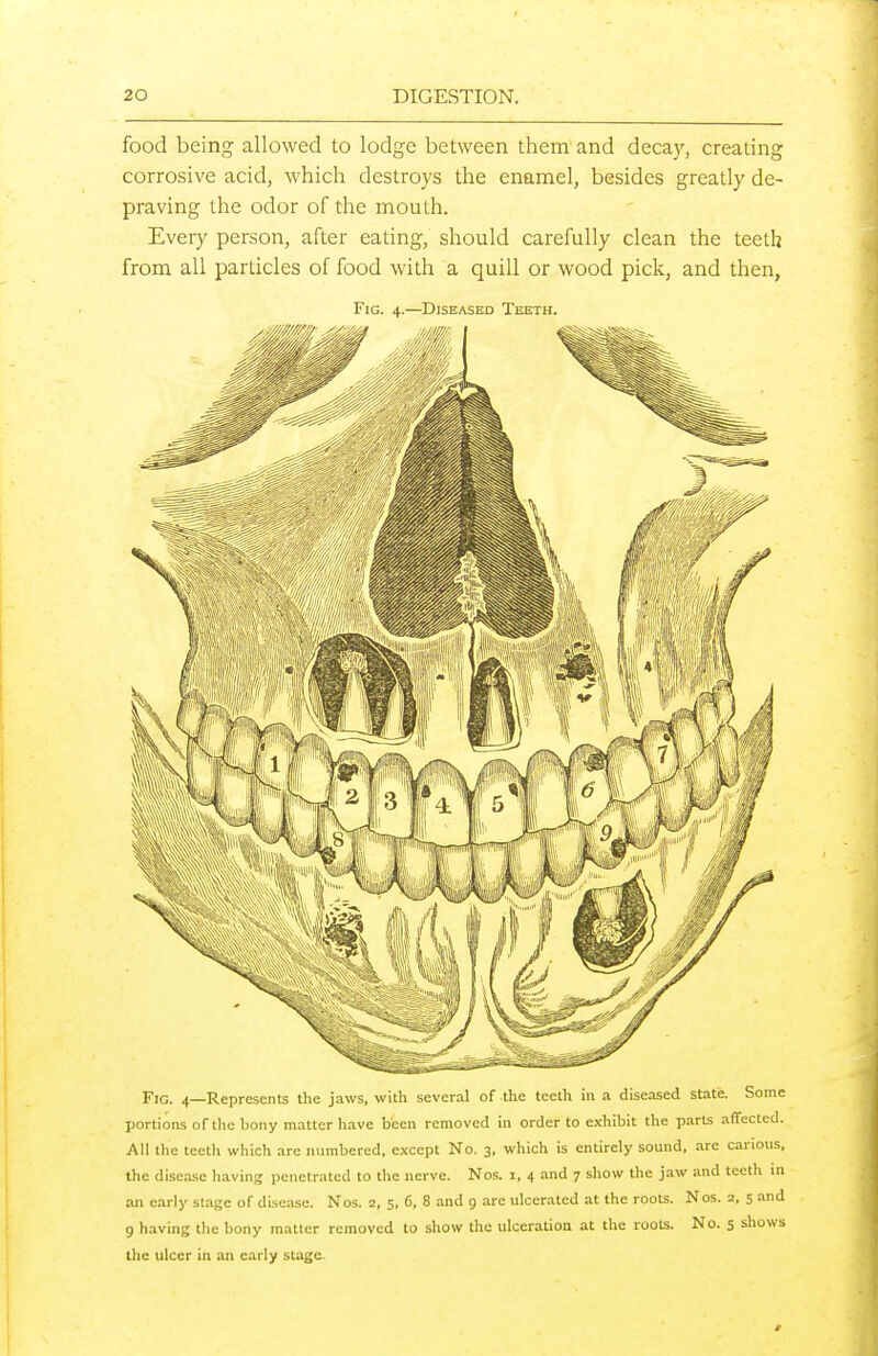 food being allowed to lodge between them and decay, creating corrosive acid, which destroys the enamel, besides greatly de- praving the odor of the mouth. Every person, after eating, should carefully clean the teeth from all particles of food with a quill or wood pick, and then, Fig. 4.—Diseased Teeth. Fig. 4—Represents the jaws, with several of the teeth in a diseased state. Some portions of the bony matter have been removed in order to exhibit the parts affected. All the teeth which are numbered, except No. 3, which is entirely sound, are carious, the disease having penetrated to the nerve. Nos. i, 4 and 7 show the jaw and teeth in an early st.igc of disease. Nos. 2, 5, 6, 8 and 9 are ulcerated at the roots. Nos. 2, 5 and 9 having the bony matter removed to show the ulceration at the roots. No. 5 shows the ulcer in an early stage