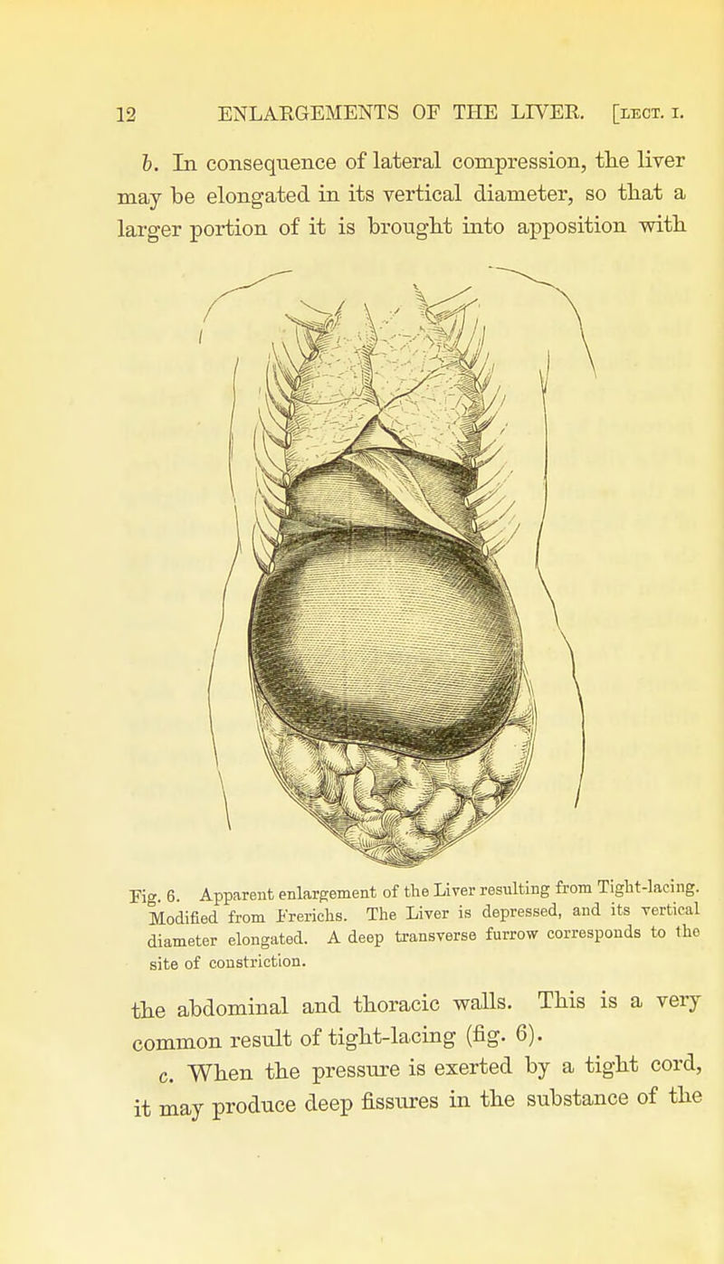 b. In consequence of lateral compression, the liver may be elongated in its vertical diameter, so that a larger portion of it is brought into apposition with Fig. 6. Apparent enlargement of the Liver resulting from Tight-lacing. Modified from Frerichs. The Liver is depressed, and its vertical diameter elongated. A deep transverse furrow corresponds to the site of constriction. the abdominal and thoracic walls. This is a very common result of tight-lacing (fig. 6). c. When the pressure is exerted by a tight cord, it may produce deep fissiires in the substance of the