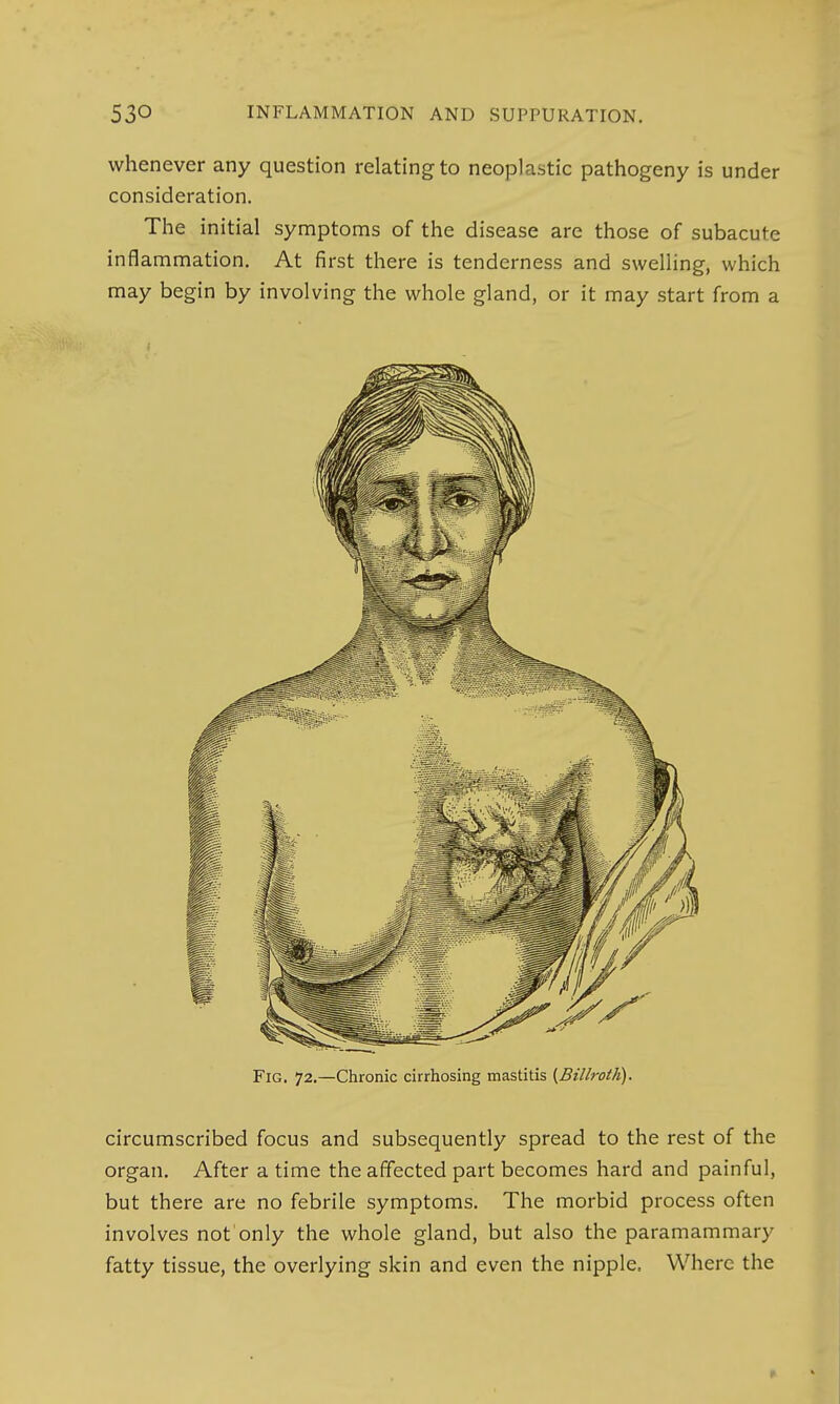 whenever any question relating to neoplastic pathogeny is under consideration. The initial symptoms of the disease are those of subacute inflammation. At first there is tenderness and swelling, which may begin by involving the whole gland, or it may start from a Fig. 72.—Chronic cirrhosing mastitis (Billroth). circumscribed focus and subsequently spread to the rest of the organ. After a time the affected part becomes hard and painful, but there are no febrile symptoms. The morbid process often involves not'only the whole gland, but also the paramammary fatty tissue, the overlying skin and even the nipple, Where the