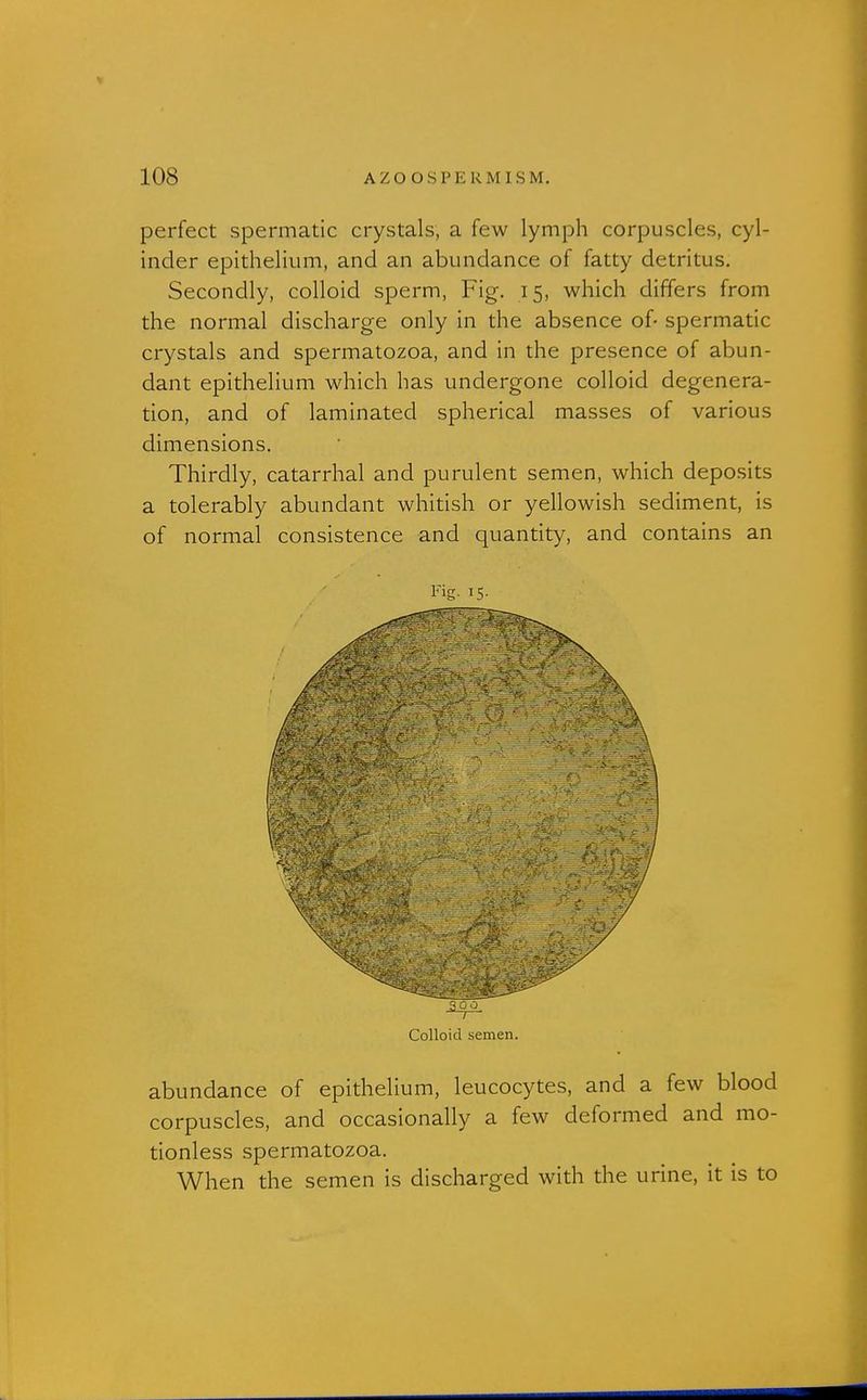 perfect spermatic crystals, a few lymph corpuscles, cyl- inder epithelium, and an abundance of fatty detritus. Secondly, colloid sperm, Fig. 15, which differs from the normal discharge only in the absence of- spermatic crystals and spermatozoa, and in the presence of abun- dant epithelium which has undergone colloid degenera- tion, and of laminated spherical masses of various dimensions. Thirdly, catarrhal and purulent semen, which deposits a tolerably abundant whitish or yellowish sediment, is of normal consistence and quantity, and contains an Fig. 15. Colloid semen. abundance of epithelium, leucocytes, and a few blood corpuscles, and occasionally a few deformed and mo- tionless spermatozoa. When the semen is discharged with the urine, it is to