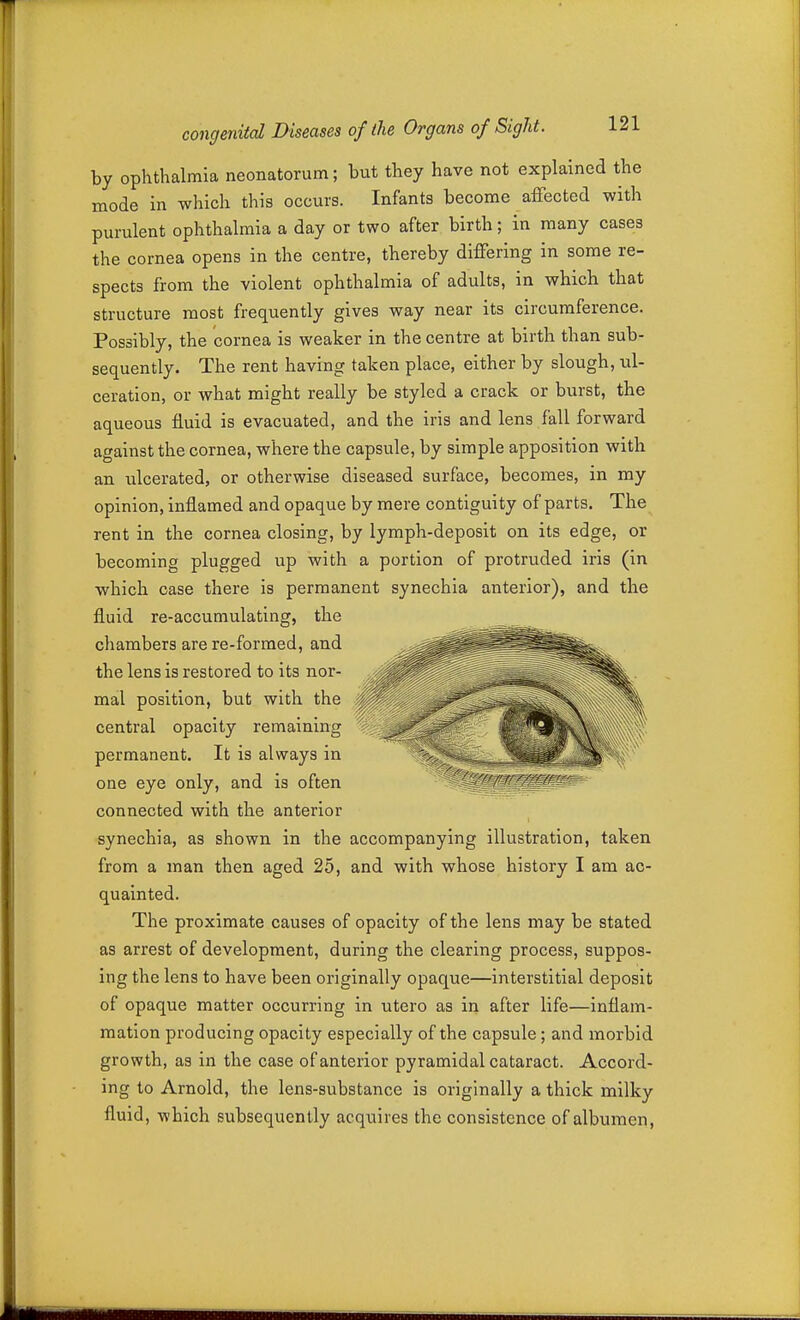 by ophthalmia neonatorum; but they have not explained the mode in which this occurs. Infants become affected with purulent ophthalmia a day or two after birth; in many cases the cornea opens in the centre, thereby differing in some re- spects from the violent ophthalmia of adults, in which that structure most frequently gives way near its circumference. Possibly, the cornea is weaker in the centre at birth than sub- sequently. The rent having taken place, either by slough, ul- ceration, or what might really be styled a crack or burst, the aqueous fluid is evacuated, and the iris and lens fall forward against the cornea, where the capsule, by simple apposition with an vilcerated, or otherwise diseased surface, becomes, in my opinion, inflamed and opaque by mere contiguity of parts. The rent in the cornea closing, by lymph-deposit on its edge, or becoming plugged up with a portion of protruded iris (in which case there is permanent synechia anterior), and the fluid re-accumulating, the chambers are re-formed, and the lens is restored to its nor- mal position, but with the central opacity remaining permanent. It is always in one eye only, and is often --^^c/g^^'ir connected with the anterior synechia, as shown in the accompanying illustration, taken from a man then aged 25, and with whose history I am ac- quainted. The proximate causes of opacity of the lens may be stated as arrest of development, during the clearing process, suppos- ing the lens to have been originally opaque—interstitial deposit of opaque matter occurring in utero as in after life—inflam- mation producing opacity especially of the capsule; and morbid growth, as in the case of anterior pyramidal cataract. Accord- ing to Arnold, the lens-substance is originally a thick milky fluid, which subsequently acqiiires the consistence of albumen.