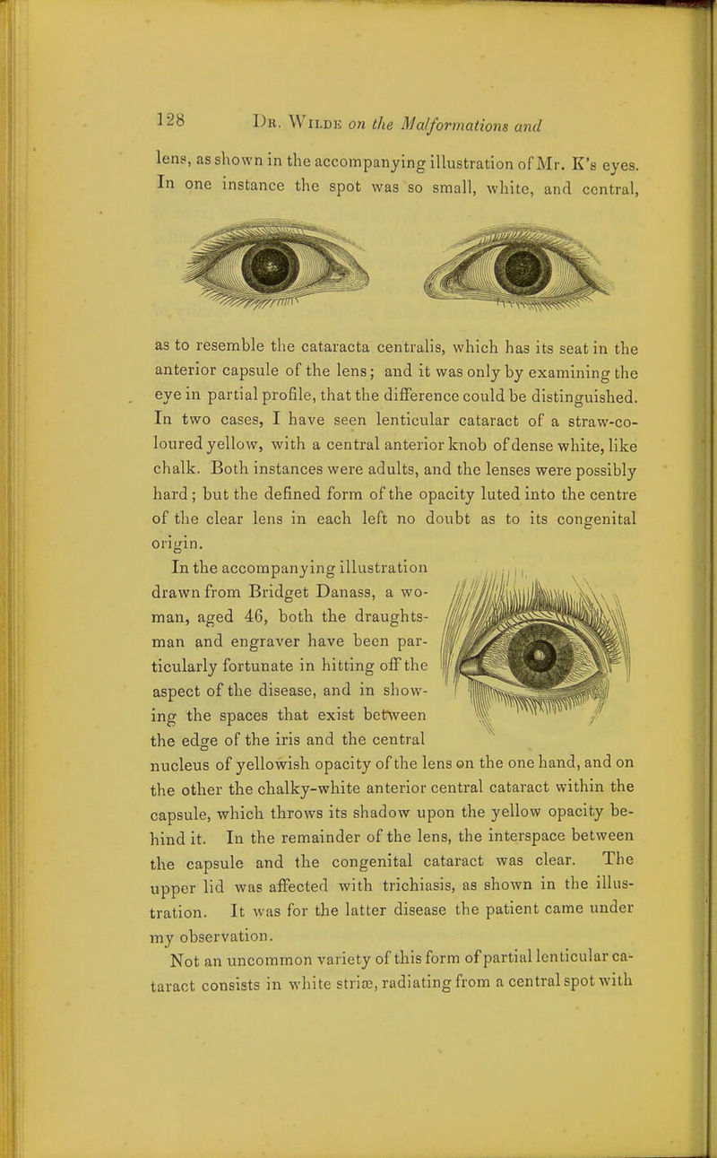 lens, as shown in the accompanying illustration of Mr. K's eyes. In one instance the spot was so small, white, and central, as to resemble the cataracta centralis, which has its seat in the anterior capsule of the lens; and it was only by examining the eye in partial profile, that the difference could be distinguished. In two cases, I have seen lenticular cataract of a straw-co- loured yellow, with a central anterior knob of dense white, like chalk. Both instances were adults, and the lenses were possibly hard ; but the defined form of the opacity luted into the centre of the clear lens in each left no doubt as to its congenital origin. In the accompanying illustration drawn from Bridget Danass, a wo- man, aged 46, both the draughts- man and engraver have been par- ticularly fortunate in hitting off the aspect of the disease, and in show- ing the spaces that exist between the edge of the iris and the central nucleus of yellowish opacity of the lens on the one hand, and on the other the chalky-white anterior central cataract within the capsule, which throws its shadow upon the yellow opacity be- hind it. In the remainder of the lens, the interspace between the capsule and the congenital cataract was clear. The upper lid was affected with trichiasis, as shown in the illus- tration. It was for the latter disease the patient came under my observation. Not an uncommon variety of this form of partial lenticular ca- taract consists in white strife, radiating from a central spot with