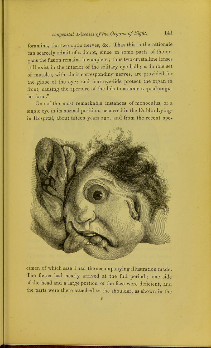 foramina, the two optic nerves, &c. That this is the rationale can scarcely admit of a doubt, since in some parts of the or- gans the fusion remains incomplete ; thus two crystalline lenses still exist in the interior of the solitary eye-ball; a double set of muscles, with their corresponding nerves, are provided for the globe of the eye; and four eye-lids protect the organ in front, causing the aperture of the lids to assume a quadrangu- lar form. One of the most remarkable instances of monoculus, or a single eye in its normal position, occurred in the Dublin Lying- in Hospital, about fifteen years ago, and from the recent spe- cimen of which case 1 had the accompanying illustration made. The foetus had nearly arrived at the full period; one side of the head and a large portion of the face were deficient, and the parts were there attached to the shoulder, as shown in the s