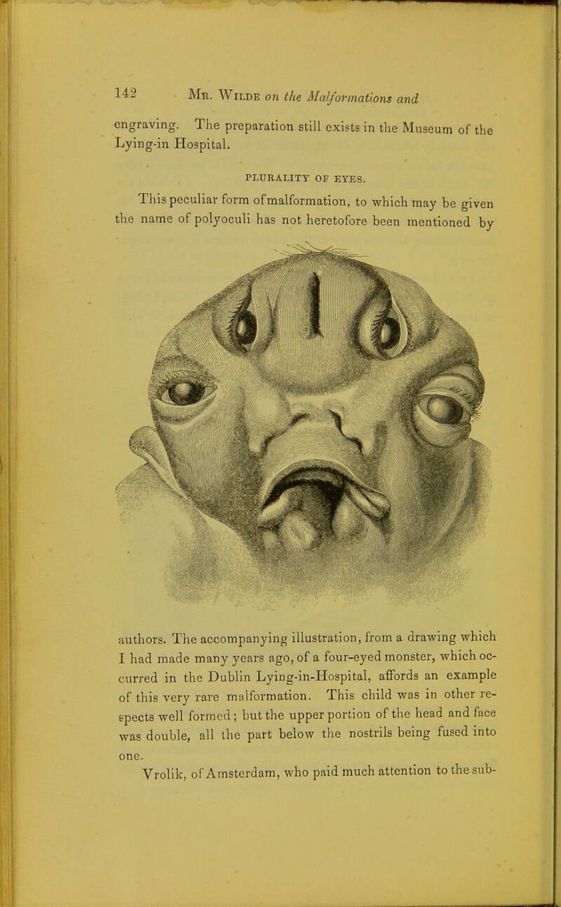 engraving. The preparation still exists in the Museum of the Lying-in Hospital. PLURALITY OF EYES. This peculiar form of malformation, to which may be given the name of polyoculi has not heretofore been mentioned by authors. The accompanying illustration, from a drawing which I had made many years ago, of a four-eyed monster, which oc- curred in the Dublin Lying-in-Hospital, affords an example of this very rare malformation. This child was in other re- spects well formed; but the upper portion of the head and face was double, all the part below the nostrils being fused into one. Vrolik, of Amsterdam, who paid much attention to the sub-