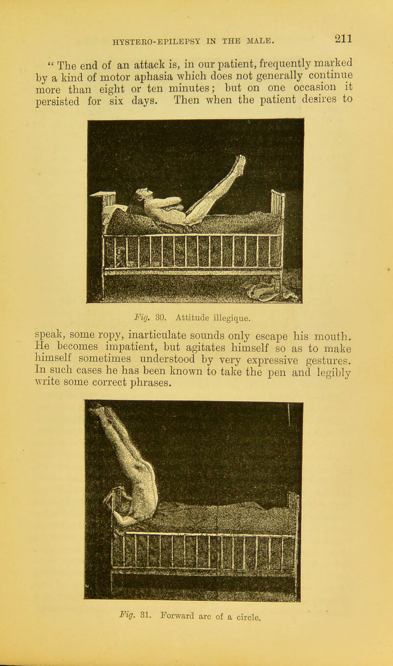  The end of an attack is, in our patient, frequently marked by a kind of motor aphasia which does not generally continue more than eight or ten minutes; but on one occasion it persisted for six days. Then when the patient desires to Fig. 30. Attitude illegique. speak, some ropy, inarticulate sounds only escape his mouth. He becomes impatient, but agitates himself so as to make himself sometimes understood by very expressive gestures. In such cases he has been known to take the pen and legibly write some correct phrases. Fig. 31. Forward arc of a circle.