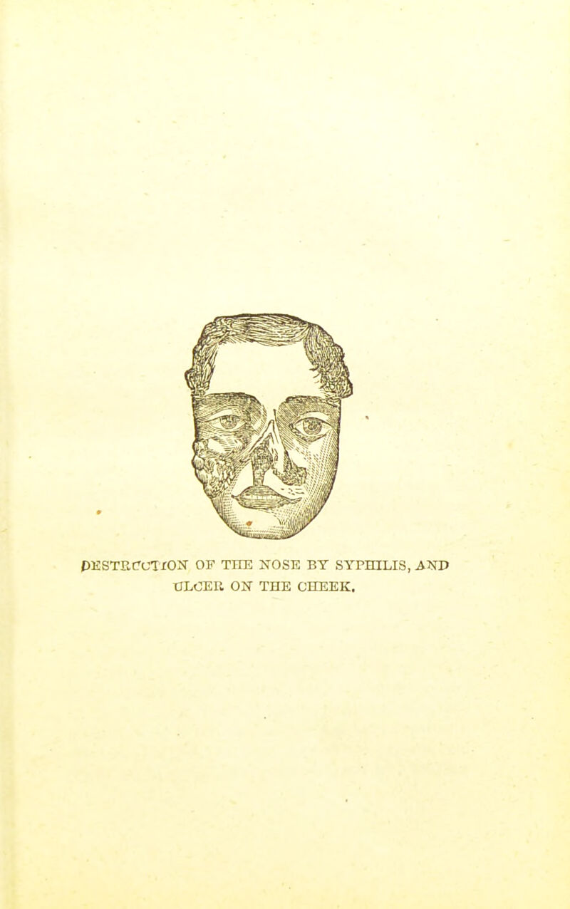 PESTSCUTION OF THE NOSE BY SYPHILIS, AOT> tlLOER ON THE CHEEK.