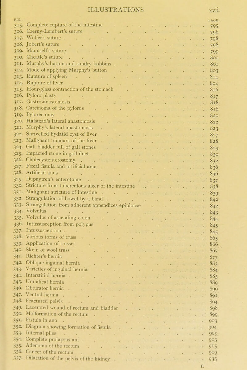 305. Complete rupture of the intestine . . . . . . . . 795 306. Czerny-Lembert's suture . . . . . . . . . . 796 307. Wolfer's suture 798 30S. Jobert's suture 798 309. Maunsell's suture ........... 799 310. Cheatle's suture 800 311. Murphy's button and sundry bobbins . . . . . . . . 801 312. Mode of applying Murphy's button 803 313. Rupture of spleen 804 314. Rupture of liver ............ 804 315. Hour-glass contraction of the stomach . . . . . . .816 316. Pyloro-plasty Si7 317. Gastro-anastomosis . . . . . . . . . . .818 318. Carcinoma of the pylorus 81S 319. Pylorectomy ............ 820 320. Halstead's lateral anastomosis . . . . . . . . . 822 321. Murphy's lateral anastomosis ......... 823 322. Shrivelled hydatid cyst of liver 827 323. Malignant tumours of the liver ......... 828 324. Gall bladder full of gall stones . . . 829 325. Impacted stone in gall duct 830 326. Cholecystenterostomy ........... 832 327. Fsecal fistula and artificial anus 836 328. Artificial anus 836 329. Dupuytren's enterotome 837 330. Stricture from tuberculous ulcer of the intestine 838 331. Malignant stricture of intestine 839 332. Strangulation of bowel by a band 842 333. Strangulation from adherent appendices epiploicee ..... 842 334. Volvulus 843 335. Volvulus of ascending colon 844 336. Intussusception from polypus 845 337. Intu.ssusception 845 338. Various forms of tru.ss S65 339. Application of trusses 866 340. Skein of wool truss 867 341. Richter's hernia 877 342. Oblique inguinal hernia 883 343. Varieties of inguinal hernia S84 344. Interstitial hernia . 885 345. Umbilical hernia 889 346. Obturator hernia . . . . . . • . . . . S90 347. Ventral hernia 891 348. Fractured pelvis 894 349. Lacerated wound of rectum and bladder 898 350. Malformation of the rectum .......... 899 351. I'lstula in ano . 903 352. Diagram showing formation of fistula 904 353. Internal piles 909 354. Complete prolapsus ani 913 355- Adenoma of the rectum 915 356. Cancer of the rectum 919 357. Dilatation of the pelvis of the kidney 935 a