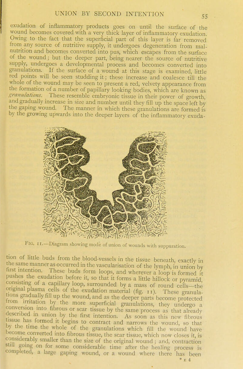 55 exudation of inflammatory products goes on until the surface of the wound becomes covered with a very thick layer of inflammatory exudation. Owing to the fact that the superficial part of this layer is far removed froni any source of nutritive supply, it undergoes degeneration from mal- nutrition and becomes converted into pus, which escapes from the surface of the wound; but the deeper part, being nearer the source of nutritive supply, undergoes a developmental process and becomes converted into granulations. If the surface of a wound at this stage is examined, little red points will be seen studding it; these increase and coalesce till the whole of the wound may be seen to present a red, velvety appearance from the formation of a number of papillary looking bodies, which are known as granulations. These resemble embryonic tissue in their power of growth, and gradually increase in size and number until they fill up the space left by the gaping wound. The manner in which these granulations are formed is by the growing upwards into the deeper layers of the inflammatory exuda- FiG. II.—Diagram .showing mode of union of wounds with suppuration. tion of little buds from the blood-vessels in the tissue beneath, exactly in the same manner as occurred in the vascularisation of the lymph, in union bv first intention. These buds form loops, and wherever a loop is formed it pushes the exudation before it, so that it forms a little hillock or pyramid consisting of a capillary loop, surrounded by a mass of round cells—the original plasma cells of the exudation material (fig. n). These -ranula- lons gradually fill up the wound, and as the deepe.-parts become protected trom irritation by the more superficial granulations, they undergo a conversion into fibrous or scar tissue by the same process as tliat already described in union by the first intention. As soon as this new fibrous tissue has formed it begins to contract and narrows the wound, so that Dy the time the whole of the granulations which fill the wound have Decome converted into fibrous tissue, the scar tissue, which now closes it, is considerably smaller than the size of the original wound ; and, contraction still going on for some considerable time after the healing process is completed, a large gaping wound, or a wound where there has been