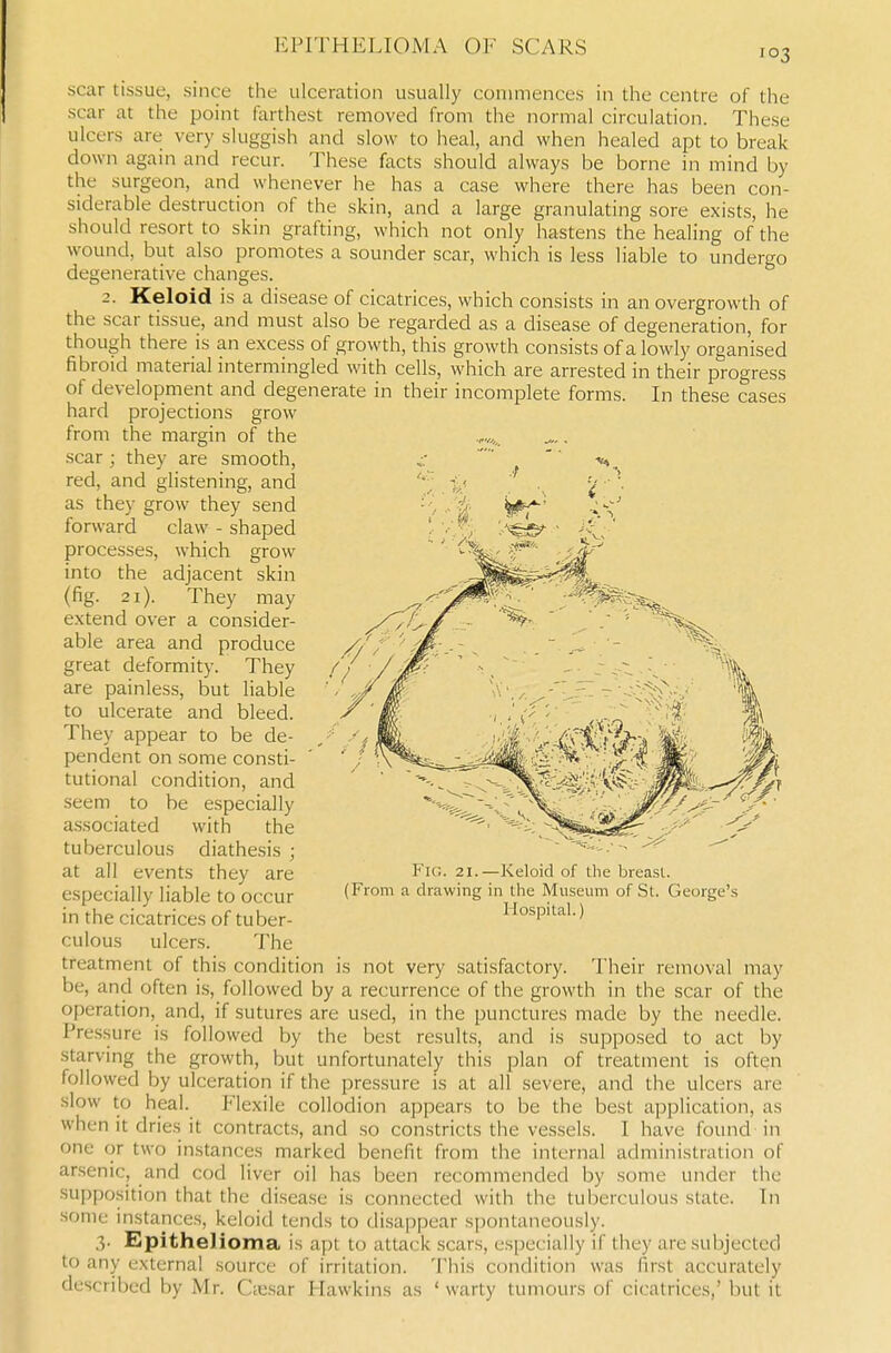 EPITHELIOMA OF SCARS scar tissue, since the ulceration usually commences in the centre of the scar at the point farthest removed from the normal circulation. These ulcers are very sluggish and slow to heal, and when healed apt to break down again and recur. These facts should always be borne in mind by the surgeon, and whenever he has a case where there has been con- siderable destruction of the skin, and a large granulating sore exists, he should resort to skin grafting, which not only hastens the healing of the wound, but also promotes a sounder scar, which is less liable to undergo degenerative changes. 2. Keloid is a disease of cicatrices, which consists in an overgrowth of the scar tissue, and must also be regarded as a disease of degeneration, for though there is an excess of growth, this growth consists of a lowly organised fibroid material intermingled with cells, which are arrested in their progress of development and degenerate in their incomplete forms. In these cases hard projections grow from the margin of the scar ; they are smooth, red, and glistening, and as they grow they send forward claw - shaped processes, which grow into the adjacent skin (fig. 2i). They may extend over a consider- able area and produce great deformity. They are painless, but liable to ulcerate and bleed. They appear to be de- pendent on some consti- tutional condition, and seem to be especially a.ssociated with the tuberculous diathesis ; at all events they are especially liable to occur in the cicatrices of tuber- culous ulcers. The treatment of this condition is not very satisfactory. Their removal may be, and often is, followed by a recurrence of the growth in the scar of the operation, and, if sutures are used, in the punctures made by the needle. Pressure is followed by the best results, and is supposed to act by starving the growth, but unfortunately this plan of treatment is often followed by ulceration if the pressure is at all severe, and the ulcers are slow to heal. Flexile collodion appears to be the best application, as when it dries it contracts, and so constricts the vessels. I have found in one or two instances marked benefit from the internal administration of arsenic, and cod liver oil has been recommended by some under the su])position that the disease is connected with the tuberculous slate. In some instances, keloid tends to disappear spontaneously. 3. Epithelioma is apt to attack scars, especially if they are subjected to any externa! source of irritation. This condition was first accurately described by Mr. Ctesar Hawkins as ' warty tumours of cicatrices,' but it Fig. 21.—Keloid of the breast. (From a drawing in the Museum of St. George's Hospital.)