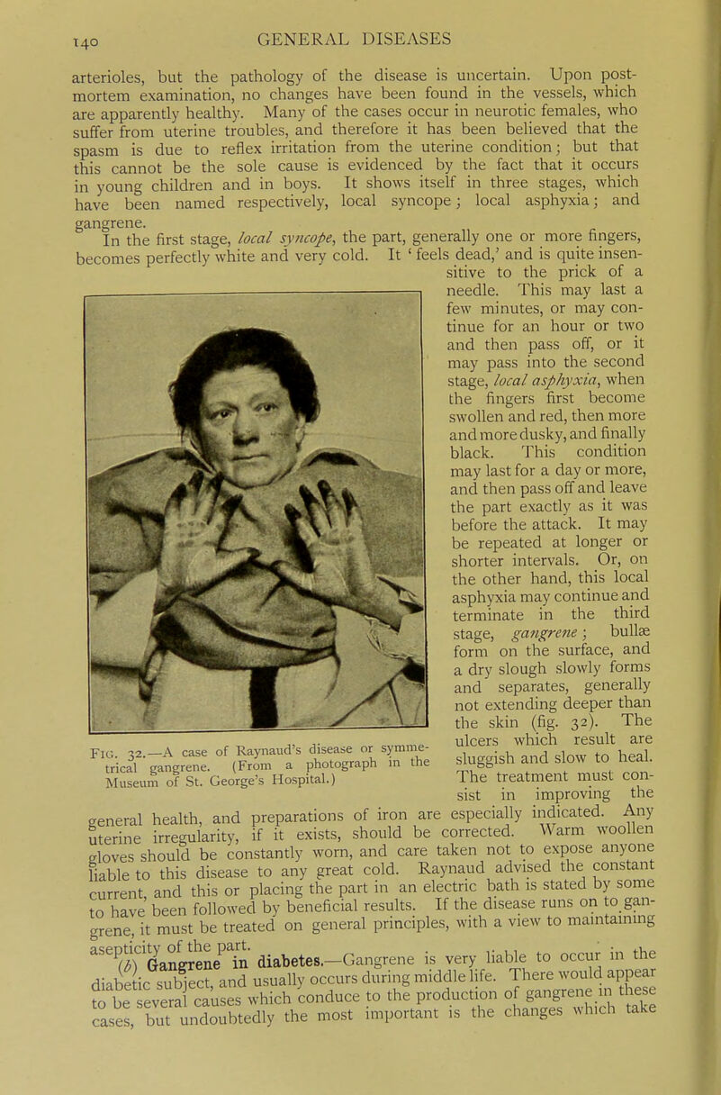 14° arterioles, but the pathology of the disease is uncertain. Upon post- mortem examination, no changes have been found in the vessels, which are apparently healthy. Many of the cases occur in neurotic females, who suffer from uterine troubles, and therefore it has been beUeved that the spasm is due to reflex irritation from the uterine condition; but that this cannot be the sole cause is evidenced by the fact that it occurs in young children and in boys. It shows itself in three stages, which have been named respectively, local syncope; local asphyxia; and gangrene. In the first stage, local syncope, the part, generally one or more fingers, becomes perfectly white and very cold. It ' feels dead,' and is quite insen- sitive to the prick of a needle. This may last a few minutes, or may con- tinue for an hour or two and then pass off, or it may pass into the second stage, local asphyxia, when the fingers first become swollen and red, then more and more dusky, and finally black. This condition may last for a day or more, and then pass off and leave the part exactly as it was before the attack. It may be repeated at longer or shorter intervals. Or, on the other hand, this local asphyxia may continue and terminate in the third stage, gangrene; bullae form on the surface, and a dry slough slowly forms and separates, generally not extending deeper than the skin (fig. 32). The ulcers which result are sluggish and slow to heal. The treatment must con- sist in improving the Fig 32 —A case of Raynaud's disease or symme- trical gangrene. (From a photograph in the Museum of St. George's Hospital.) general health, and preparations of iron are especially indicated. Any uterine irregularity, if it exists, should be corrected. Warm woollen doves should be constantly worn, and care taken not to expose anyone liable to this disease to any great cold. Raynaud advised the constant current, and this or placing the part in an electric bath is stated by some to have been followed by beneficial results. If the disease runs on to gan- grene, it must be treated on general principles, with a view to maintainmg '^i a'an'g^ene't' diabetes-Gangrene is very liable to occur in the diabe ic subject, and usually occurs during middle life. There would appear to be evera causes which conduce to the production of gangrene in these cases, but undoubtedly the most important is the changes which take
