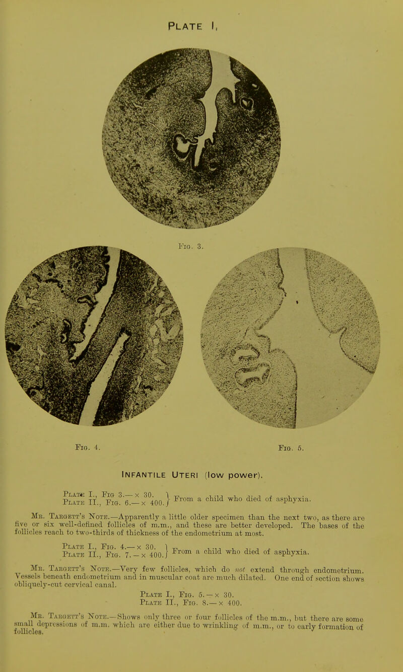 Fig. 3. 4 4 ••-''^ w • 1 Fig. 4. Fig. 5. Infantile Uteri (low power). p™ n. Ffig3'67-x°4oo.} From a child who died of asPhyxia- Me. Taegett's Note.—Apparently a little older specimen than the next two, as there arc five or six well-defined follicles of ra.m., and these are hetter developed. The bases of the follicles reach to two-thirds of thickness of the endometrium at most. Plate I,, Fig. 4.— x 30. Plate II., Fig. 7. — x 400 j From a child who died of asphyxia. Me. Taegett's Note.—Very few follicles, which do not extend through endometrium. Vessels beneath endometrium and in muscular coat are much dilated. One end of section shows obliquely-cut cervical canal. Plate I., Fig. 5. — x 30. Plate II., Fig. 8.—x 400. Me. Targett's Note.—Shows only three or four follicles of the m.m., but there are some small depressions of m.m. which are either due to wrinkling of m.m., or to early formation of follicles. •