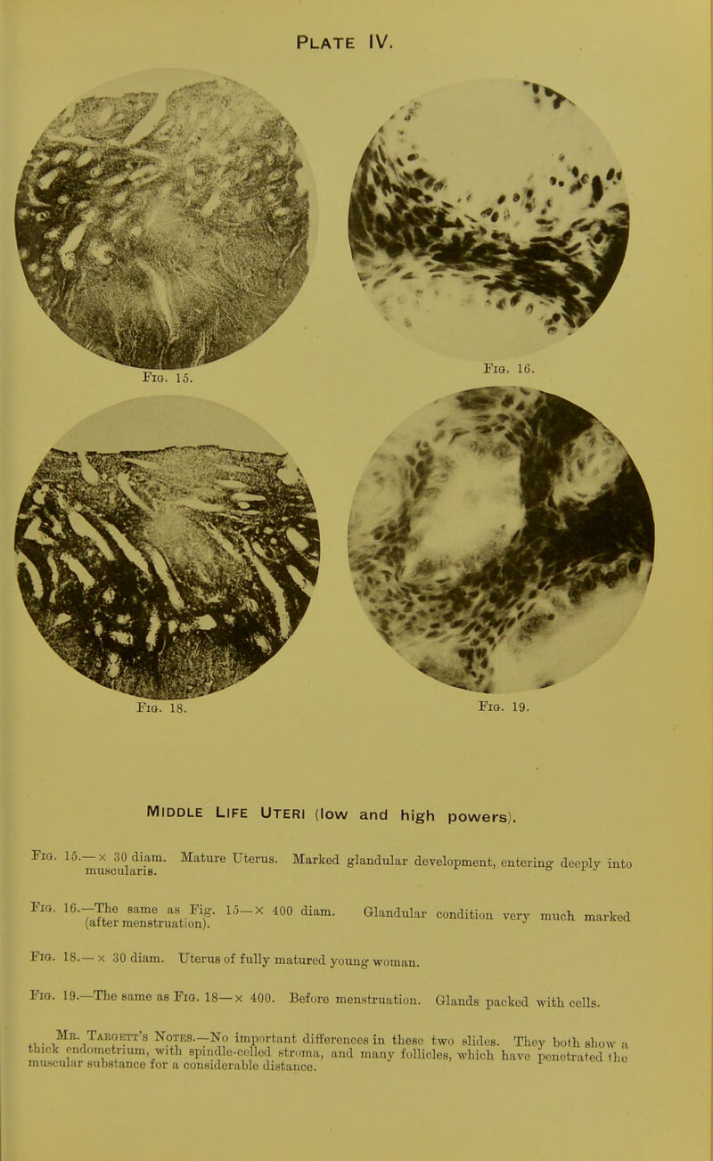 Fig. 15. 1 Fig. 18. Fig. 19. Middle Life Uteri (low and high powers). Fig. 15.— x 30 diam. Mature Uterus. Marked glandular development, entering deeply into muscularis. Fig. 16.-The same as Fig. 15-X 400 diam. Glandular condition very much marked (atter menstruation).  Fig. 18.—x 30 diam. Uterus of fully matured young woman. Fig. 19.—The same as Fig. 18—x 400. Before menstruation. Glands packed with cells. Mb. Taroktt's Notes.—No important differences in these two slides. They both show a thick endometrium, with sprndle-cefled stroma, and many follicles, which have penetrated the
