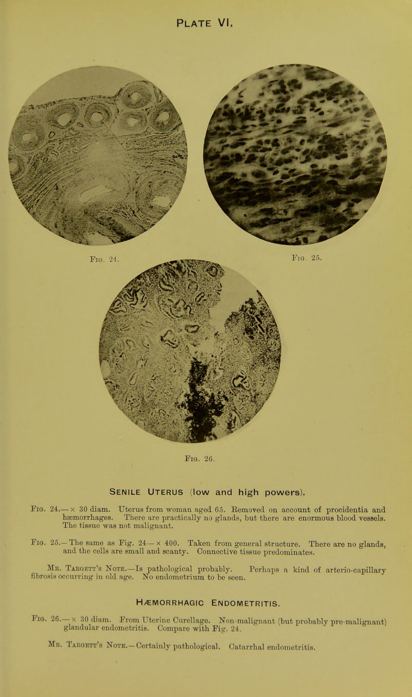 Fig. 26. Senile Uterus (low and high powers). Fig. 24.— x 30 diam. Uterus from woman aged 65. Removed on account of procidentia and hsemorrhages. There are practically no glaDds, but there are enormous blood vessels. The tissue was not malignant. Fio. 25.-The same as Fig. 24—x 400. Taken from general structure. There are no glands, and the cells are small and scanty. Connective tissue predominates. Mr. Taegett's Note.—Is pathological probably. Perhaps a kind of arterio-capillary fibrosis occurring in old age. No endometrium to be seen. H/EMORRHAGIC ENDOMETRITIS. Fig. 26.— x 30 diam. From Uterine Curellage. Non-malignant (but probably pro-malignant) glandular endometritis. Compare with Fig. 24. Mr. Tabgbtt's Note.-Certainly pathological. Catarrhal endometritis.
