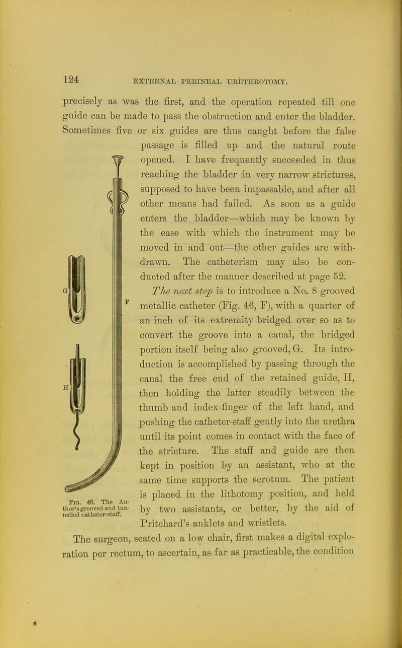 precisely as was the first, and the operation repeated till one guide can be made to pass the obstruction and enter the bladder. Sometimes five or six guides are thus caught before the false passage is filled up and the natural route opened. I have frequently succeeded in thus reaching the bladder in very narrow stnctures, supposed to have been impassable, and after all other means had failed. As soon as a guide enters the bladder—which may be known by the ease with which the instrument may be moved in and out—the other guides are with- di'awn. The catheterism may also be con- ducted after the manner described at page 52. The next stejp is to introduce a Ko. 8 grooved metallic catheter (Fig. 46, F), with a quarter of an inch of its extremity bridged over so as to convert the groove into a canal, the bridged portion itself being also grooved, G. Its intro- duction is accomplished by passing through the canal the fi'ee end of the retained guide, H, tlien holding the latter steadily between the thumb and index-finger of the left hand, and pushing the catheter-staff gently into the urethra until its point comes in contact with the face of the stricture. The staff and guide are then kept in position by an assistant, who at the same time supports the scrotum. The patient is placed in the lithotomy position, and held by two assistants, or better, by the aid of Pritchard's anklets and wristlets. The surgeon, seated on a low chair, first makes a digital explo- ration per rectum, to ascertain, as far as practicable, the condition H Fio. 46. The Au- thor's grooved and tun- nelled cathetcr-8ta£E.