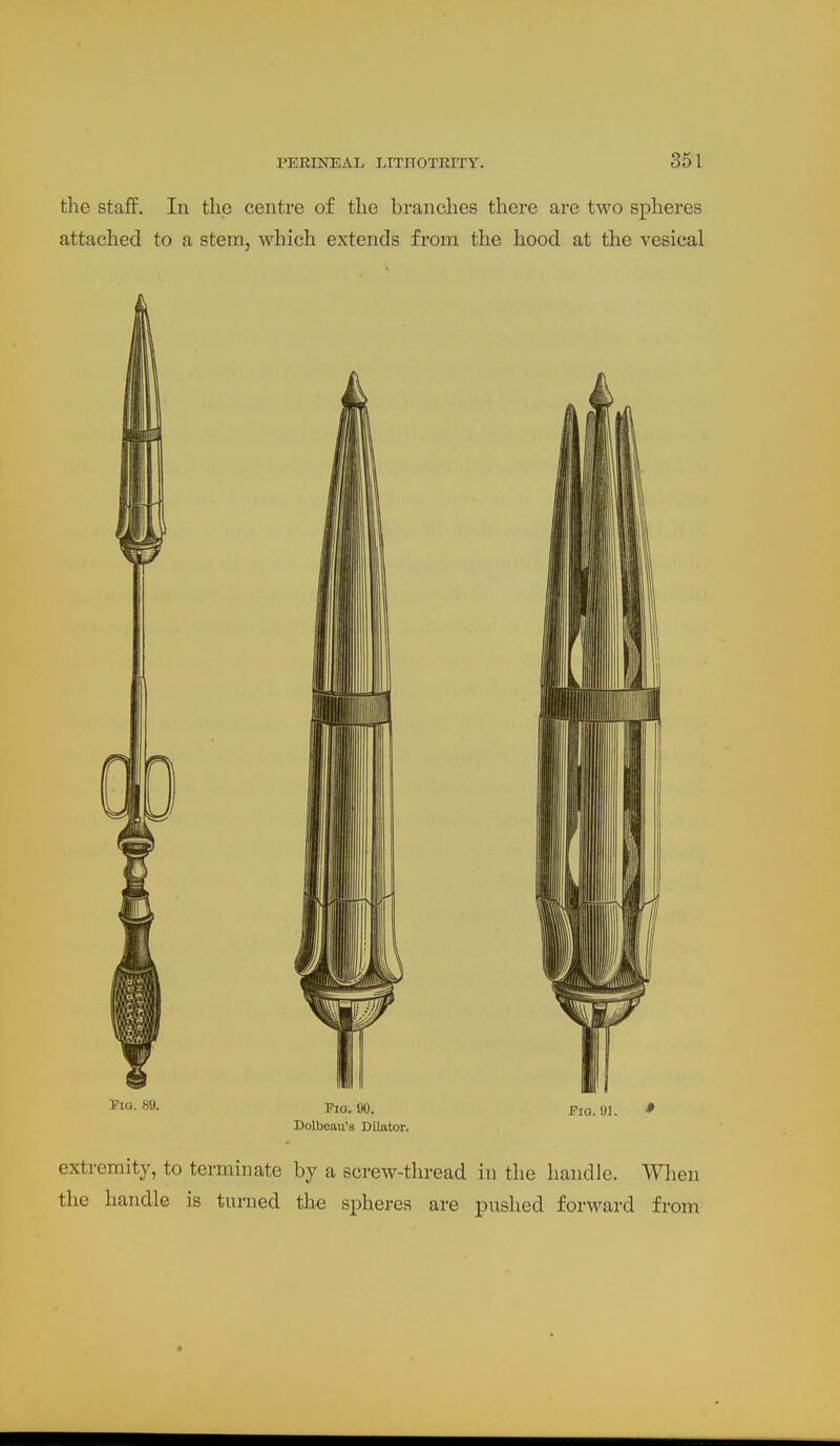 PERINEAL LITnOTEITY. 35 1 the staff. In the centre of the branches there are two spheres attached to a stem, which extends from the hood at the vesical Bolbeau's Dilator, extremity, to terminate by a screw-thread in the handle. Wlien the handle is turned the spheres are pushed forward from