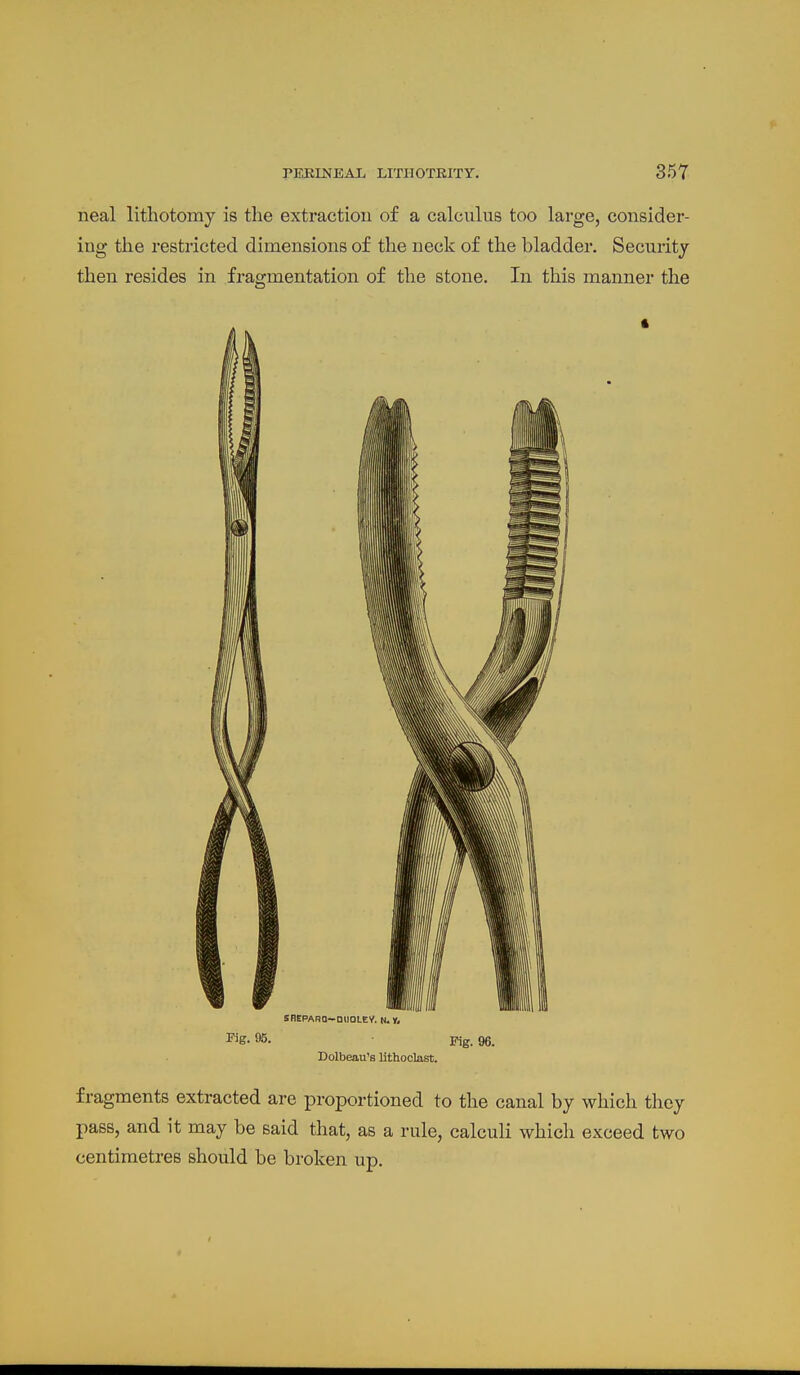 neal lithotomy is the extraction of a calculus too large, consider- ing the restricted dimensions of the neck of the bladder. Security then resides in fragmentation of the stone. In this manner the SflEPAHQ-QllOLEV. N. 1. ^'g- 95. Pig. 96. Dolbeau's lithoolast. fragments extracted are proportioned to the canal by which tlicy pass, and it may be said that, as a rule, calculi which exceed two centimetres should be broken up.