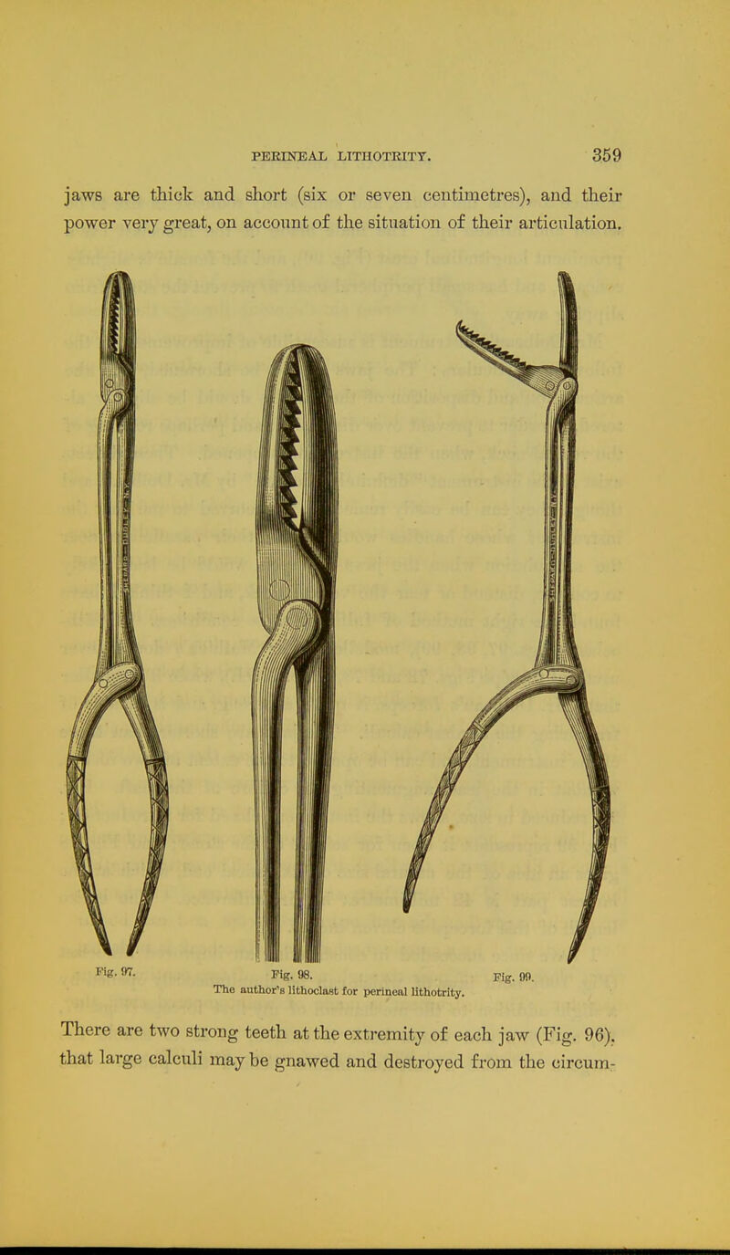 jaws are thick and short (six or seven centimetres), and their power very great, on account of the situation of their articulation. ^g- ^- Fig. 98. Fig. 00. The author's lithoclasfc for perineal llthotrity. There are two strong teeth at the extremity of each jaw (Fig. 96). that large calculi may be gnawed and destroyed from the circum-