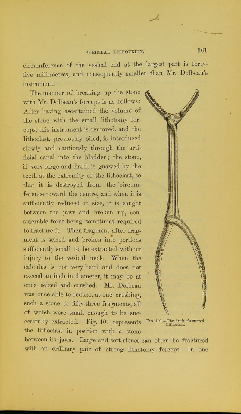 circumference of the vesical end at the largest part is forty- five millimetres, and consequently smaller than Mr. Dolbeau's instrument. The manner of breaking up the stone with Mr. Dolbeau's forceps is as follows: After having ascertained the volume of the stone with the small lithotomy for- ceps, this instrument is removed, and the lithoclast, previously oiled, is introduced slowly and cautiously through the arti- ficial canal into the bladder; the stone, if very large and hard, is gnawed by the teeth at the extremity of the lithoclast, so that it is destroyed fi*ora the circum- ference toward the centre, and when it is sufiiciently reduced in size, it is caught between the jaws and broken up, con- siderable force being sometimes required to fracture it. Then fragment after frag- ment is seized and broken into portions sufiiciently small to be extracted without injury to the vesical neck. When the calculus is not very hard and does not exceed an inch in diameter, it may be at once seized and crushed. Mr. Dolbeau was once able to reduce, at one crushing, such a stone to fifty-three fragments, all of which were small enough to be suc- cessfully extracted. Fig. 101 represents the lithoclast in position with a stone between its jaws. Large and soft stones can often be fractured with an ordinary pair of strong lithotomy forceps. In one Pio. 100.—The Author's curved Lithoclast.