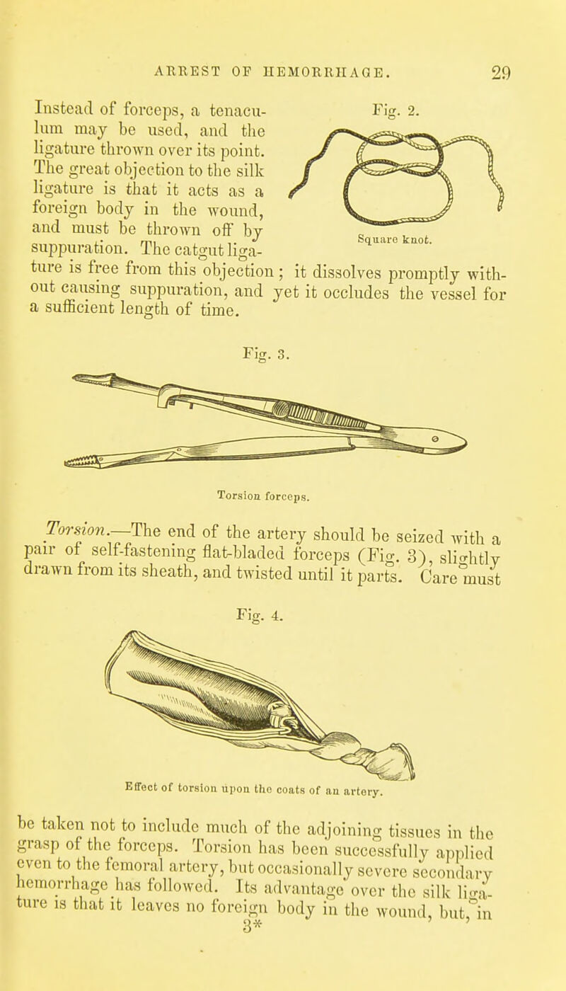 Instead of forceps, a tenacu- lum may be used, and the ligature thrown over its point. The great objection to the silk ligature is that it acts as a foreign bodj in the wound, and must be thrown off bj suppuration. The catgut liga- ture is free from this objection; it dissolves promptly with- out causing suppuration, and yet it occludes the vessel for a sufficient length of time. Squiii-c knot. Fig. 3. Torsion forceps. Torsion.—end of the artery should be seized with a pair ot self-fastening flat-bladed forceps (Fio-. 3) sli<Thtlv drawn from its sheath, and twisted until it parti Care must Effect of torsion upon tho coats of an artory. be taken not to include much of the adjoining tissues in the grasp of the forceps. Torsion has been successfully applied even to the femoral artery, but occasionally severe secondary hemorrhage has followed. Its advantage over the silk lio-a- ture is that it leaves no foreign body in the wound, but''in