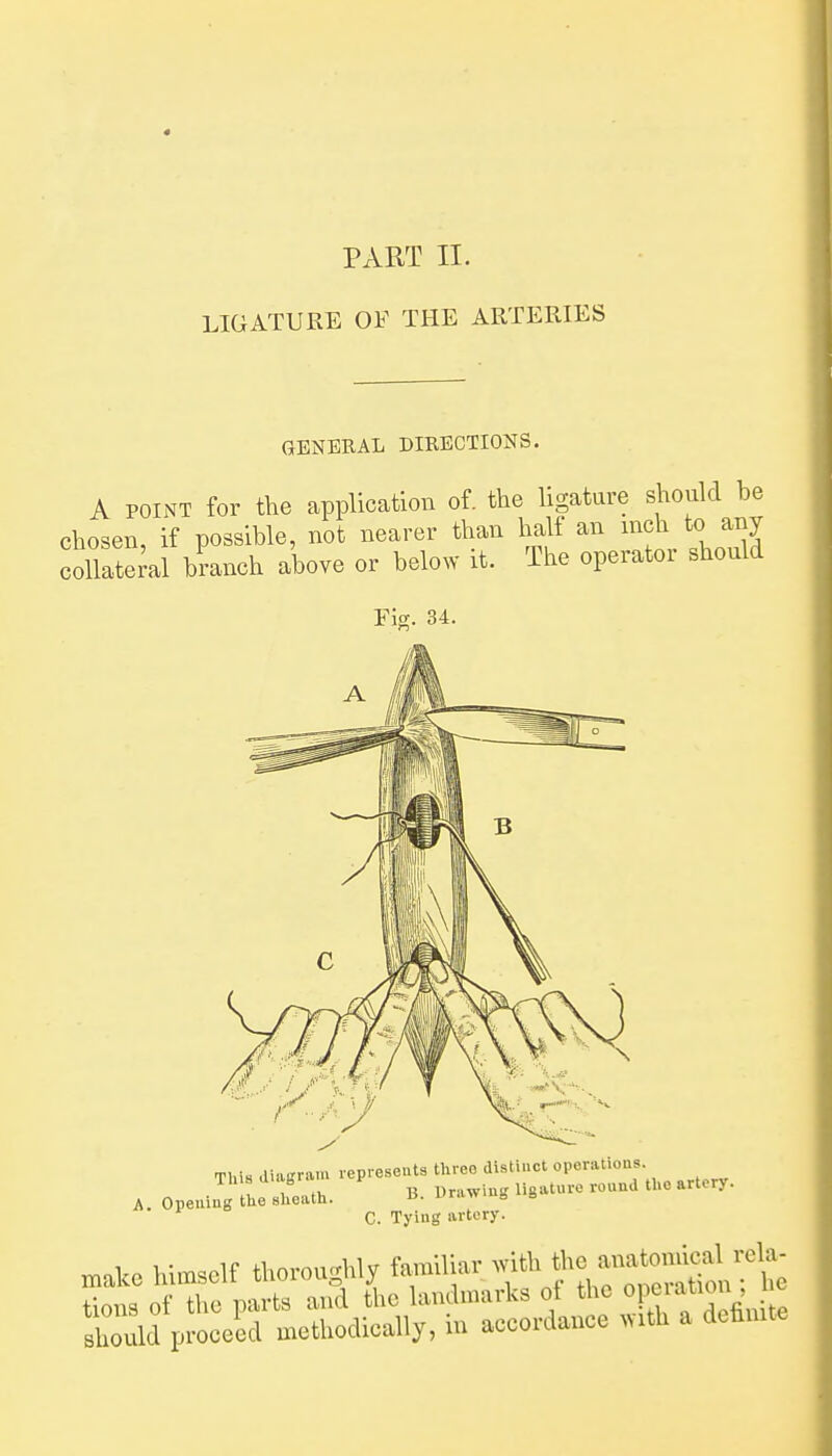 LIGATURE OF THE ARTERIES GENEEAL DIRECTIONS. A POINT for the application of. the ligature should be chosen, if possible, not nearer than half an ^ch to any collateral branch above or below it. The operatoi should Fig. 34. This diagraiu represents three distinct operations , , ,1, B Drawing ligaturo round tUe artery. A. Opening tlie sheath. u. i-raw s » C. Tying artery. „.alce himself tl.orouc^.ly f^Biliar -^f^f ^ tions of the parts and the landmarks ot the ^^^^^^^' . Bl^uld proceid methodically, in accordance with a defimte