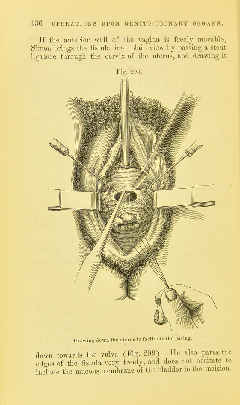 ■ If the anterior wall of the vagina is freely movable, Simon brings the fistula into plain view by passing a stout ligature throuo;h the cervix of the uterus, and drawing it Fig. 299. Drawing down the uterus to facilitate the paring. down towards the vulva (Fig. 299). He also pares the ed<Tes of the fistula very freely, and does not hesitate to include the mucous membrane of the bladder m the incision.