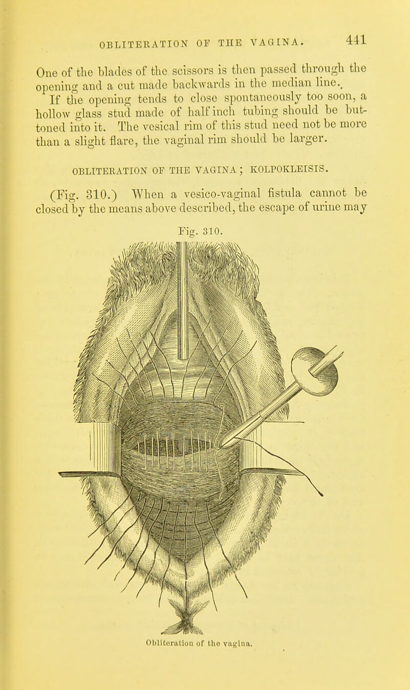 One of the blades of the scissors is then passed through the opening and a cut made backwards in the median line.. If the opening tends to close spontaneously too soon, a hollow glass stud made of half inch tubing should be but- toned into it. The vesical rim of this stud need not be more than a slight flare, the vaginal rim should be larger. OBLITERATION OP THE VAGINA ; KOLPOKLEISIS. (Fig. 310.) When a vesico-vaginal fistula cannot be closed by the means above described, the escajje of urine may Fig. 310. Obliteration of the vagina.