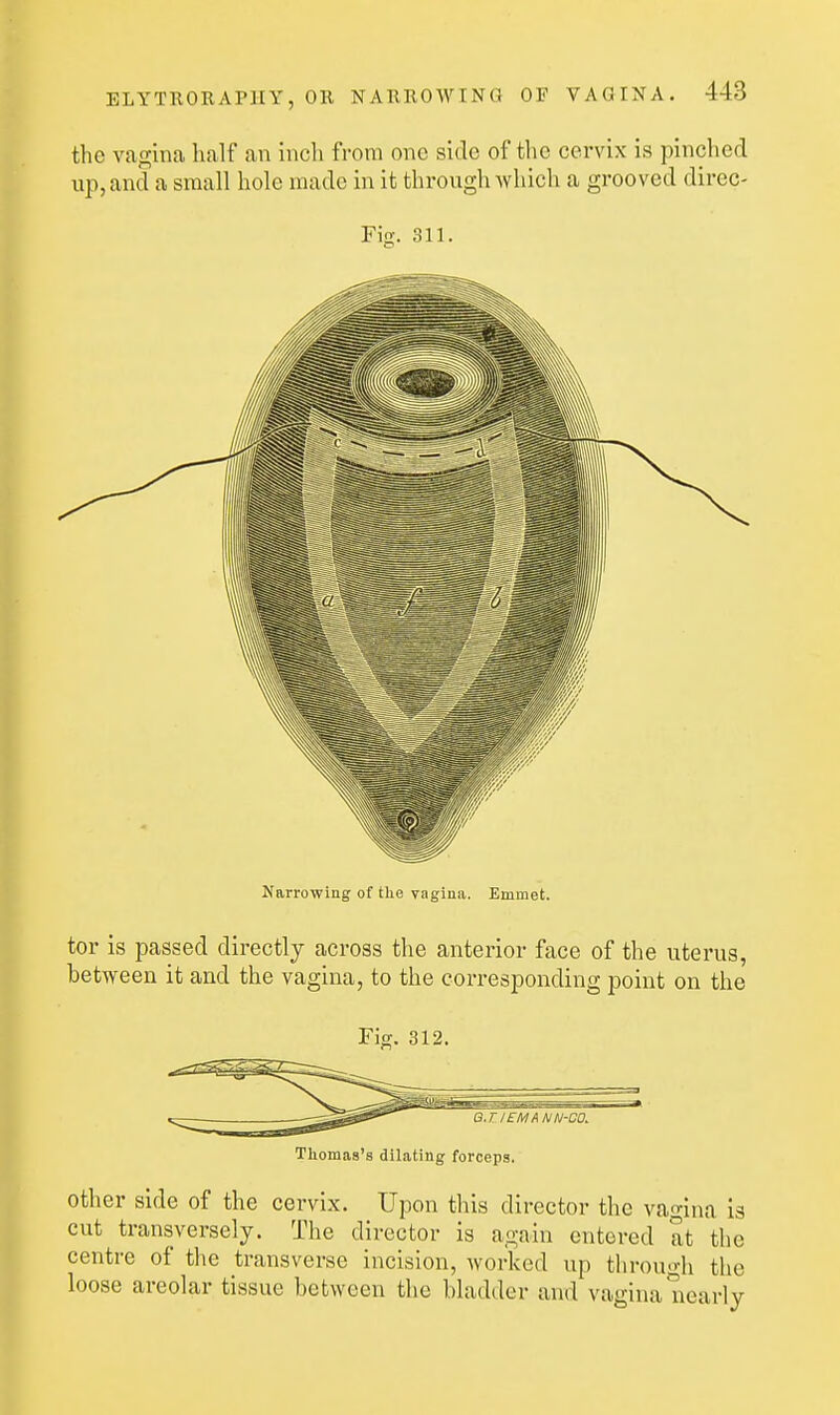 the vap;ina half an inch from one side of the cervix is pinched up, and a small hole made in it through which a grooved direc- Fig. 311. Narrowing of the vaginiv. Emmet. tor is passed directly across the anterior face of the uterus, between it and the vagina, to the corresponding point on the Fig. 312. ---- (gTiif Q.T lEMA NN-CO. Thomas's dilating forceps. Other side of the cervix. Upon this director the vagina is cut transversely. The director is again entered at the centre of the transverse incision, worked up through the loose areolar tissue between the bladder and vagina nearly