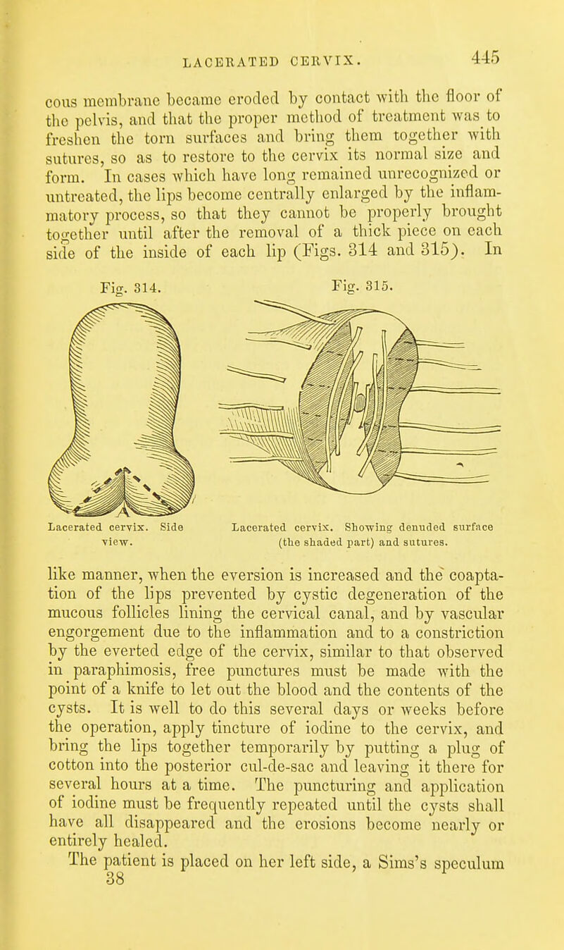 LACERATED CERVIX. cous membrane became eroded by contact with the floor of the pelvis, and that the proper method of treatment was to freshen the torn surfaces and bring them together with sutures, so as to restore to the cervix its normal size and form. In cases which have long remained unrecognized or xmtreated, the lips become centrally enlarged by the inflam- matory process, so that they cannot be properly brought together until after the removal of a thick piece on each side of the inside of each lip (Figs. 314 and 315). In Fit. 314. Fig. 315. Lacerated cervix. Side Lacerated cervix. Showing denuded surface view. (the shaded part) and sutures. like manner, when the eversion is increased and the coapta- tion of the lips prevented by cystic degeneration of the mucous follicles lining the cervical canal, and by vascular engorgement due to the inflammation and to a constriction by the everted edge of the cervix, similar to that observed in paraphimosis, free punctures must be made Avith the point of a knife to let out the blood and the contents of the cysts. It is well to do this several days or weeks before the operation, apply tincture of iodine to the cervix, and bring the lips together temporarily by putting a plug of cotton into the posterior cul-de-sac and leaving it there for several hours at a time. The puncturing and application of iodine must be frequently repeated until the cysts shall have all disappeared and the erosions become nearly or entirely healed. The patient is placed on her left side, a Sims's speculum 38