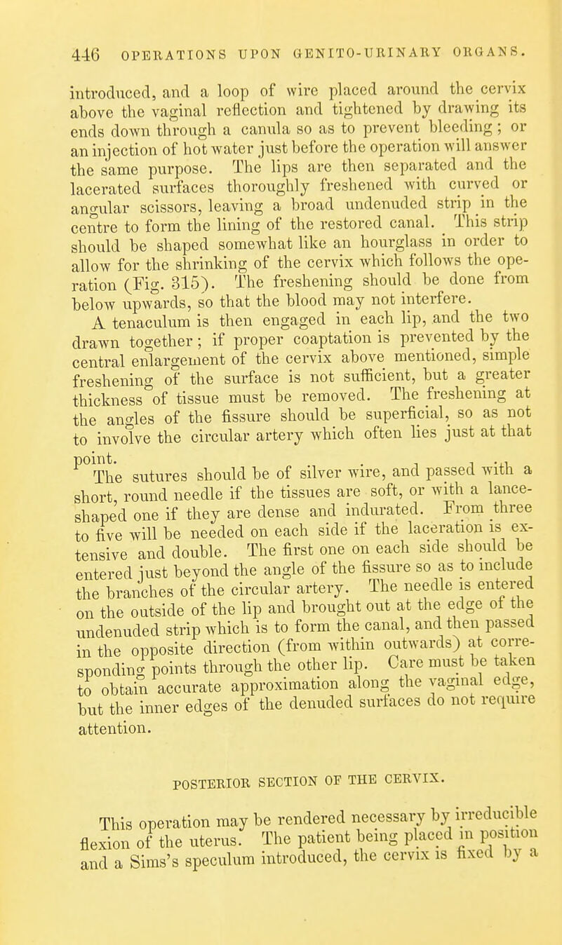 introduced, and a loop of wire placed around the cervix above the vaginal reflection and tightened by drawing its ends down through a canula so as to prevent bleeding ; or an injection of hot water just before the operation will answer the same purpose. The lips are then separated and the lacerated surfaces thoroughly freshened with curved or angular scissors, leaving a broad undenuded strip in the centre to form the lining of the restored canal. This strip should be shaped somewhat like an hourglass in order to allow for the shrinking of the cervix which follows the ope- ration (Fig. 315). The freshening should be done from below upwards, so that the blood may not interfere. A tenaculum is then engaged in each lip, and the two drawn together; if proper coaptation is prevented by the central enlargement of the cervix above mentioned, simple freshening of the surface is not sufficient, but a greater thickness of tissue must be removed. The freshening at the angles of the fissure should be superficial, so as not to involve the circular artery which often lies just at that ^°The sutures should be of silver wire, and passed with a short, round needle if the tissues are soft, or with a lance- shaped one if they are dense and indurated. From three to live will be needed on each side if the laceration is ex- tensive and double. The first one on each side should be entered iust beyond the angle of the fissure so as to include the branches of the circular artery. The needle is entered on the outside of the lip and brought out at the edge ot the undenuded strip which is to form the canal, and then passed in the opposite direction (from within outwards) at corre- snondinc. points through the other lip. Care must be taken to obtain accurate approximation along the vaginal edge, but the inner edges of the denuded surfaces do not recimre attention. POSTERIOR SECTION OE THE CERVIX. This operation may be rendered necessary by irreducible flexion of the uterus. The patient being placed in position and a Sims's speculum introduced, the cervix is fixed by a