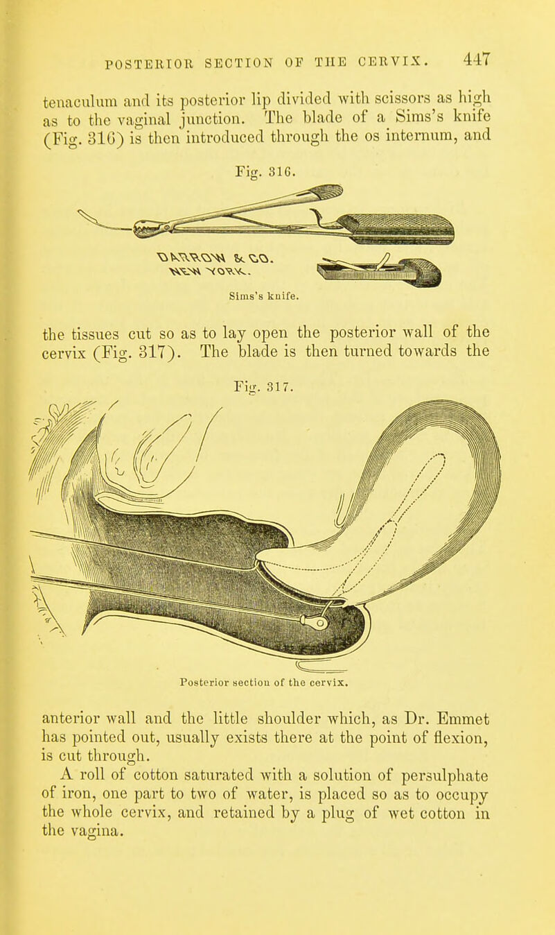 tenaculum and its posterior lip divided with scissors as high as to the vaginal junction. The blade of a Sims's knife (Fig. 316) is then introduced through the os internum, and Fig. 316. Sims's kaife. the tissues cut so as to lay open the posterior wall of the cervix (Fig. 317). The blade is then turned towards the Fig. 317. Posterior section of the cervix. anterior wall and the little shoulder which, as Dr. Emmet has pointed out, usually exists there at the point of flexion, is cut through. A roll of cotton saturated with a solution of persulphate of iron, one part to two of water, is placed so as to occupy the whole cervix, and retained by a plug of wet cotton in the vagina.