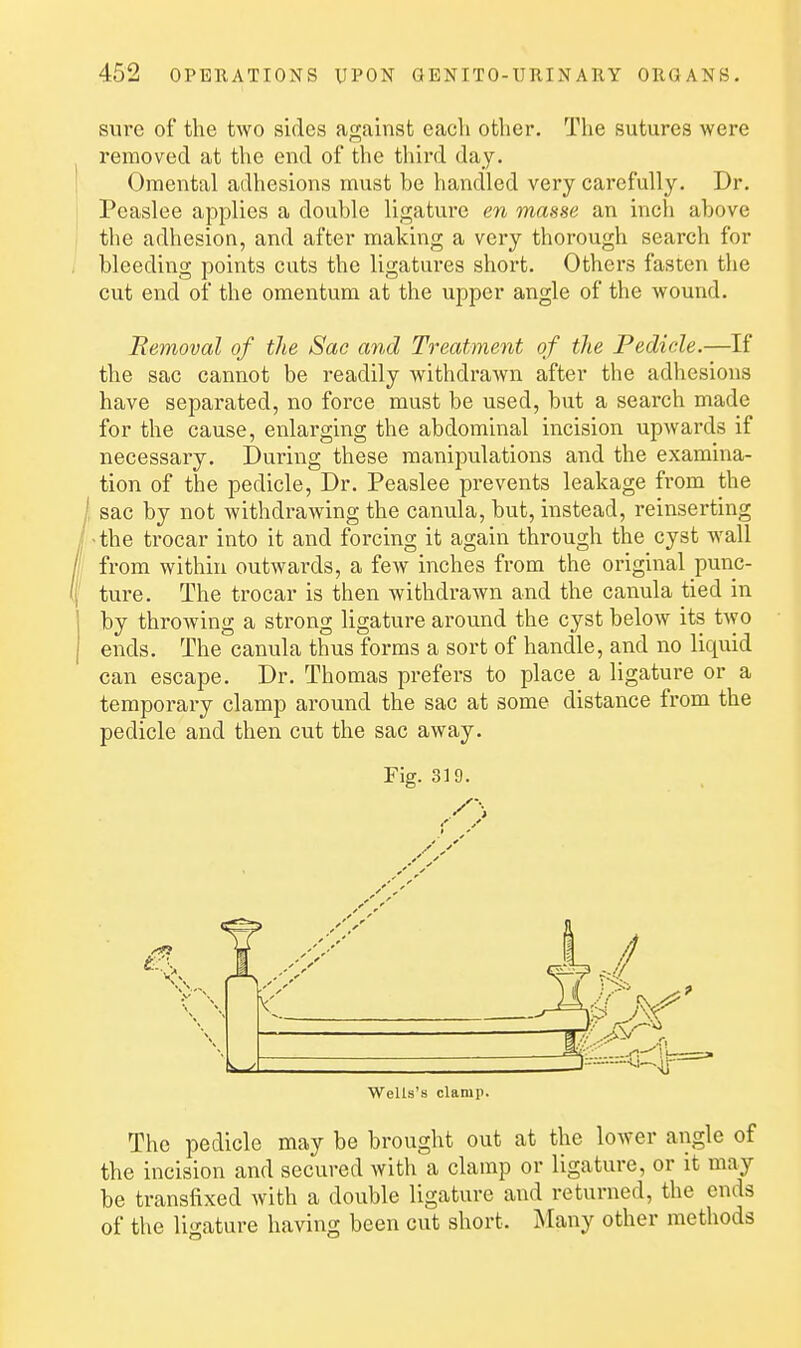 sure of the two sides against eacli other. The sutures were removed at the end of the third day. Omental adhesions must be handled very carefully. Dr. Peaslee applies a double ligature en masse an inch above the adhesion, and after making a very thorough search for bleeding points cuts the ligatures short. Others fasten the cut end of the omentum at the upper angle of the wound. Removal of the Sac and Treatment of the Pedicle.—If the sac cannot be readily withdrawn after the adhesions have separated, no force must be used, but a search made for the cause, enlarging the abdominal incision upwards if necessary. During these manipulations and the examina- tion of the pedicle. Dr. Peaslee prevents leakage from the sac by not withdrawing the canula, but, instead, reinserting •the trocar into it and forcing it again through the cyst wall from within outwards, a few inches from the original punc- ture. The trocar is then withdrawn and the canula tied in by throwing a strong ligature around the cyst below its two ends. The canula thus forms a sort of handle, and no liquid can escape. Dr. Thomas prefers to place a ligature or a temporary clamp around the sac at some distance from the pedicle and then cut the sac away. Fig. 319. Wells's clamp. The pedicle may be brought out at the lower angle of the incision and secured with a clamp or ligature, or it may be transfixed with a double ligature and returned, the ends of the ligature having been cut short. Many other methods