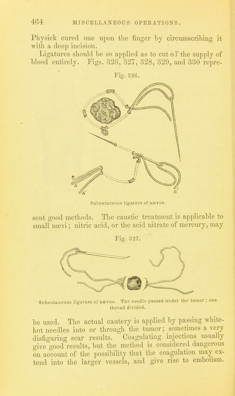 riiysiclc cured one upon the finger by circumscribing it with a deep incision. Ligatures should be so applied as to cut o.T the supply of blood entirely. Figs. 326, 827, 328, 329, and 330 reprc- Flg. 32G. Suljcutaneous ligature of najvus. sent good methods. The caustic treatment is applicable to small neevi; nitric acid, or the acid nitrate of mercury, may Fig. 327. Subcutaneous ligature of najvus. The needle passed under the tumor ; one thread divided. be used. The actual cautery is applied by passing white- hot needles into or through the tumor; sometimes a very disfiguring scar results. Coagulating injections usually give good results, but the method is considered dangerous on account of the possibility that the coagulation may ex- tend into the larger vessels, and give rise to embolism. 1