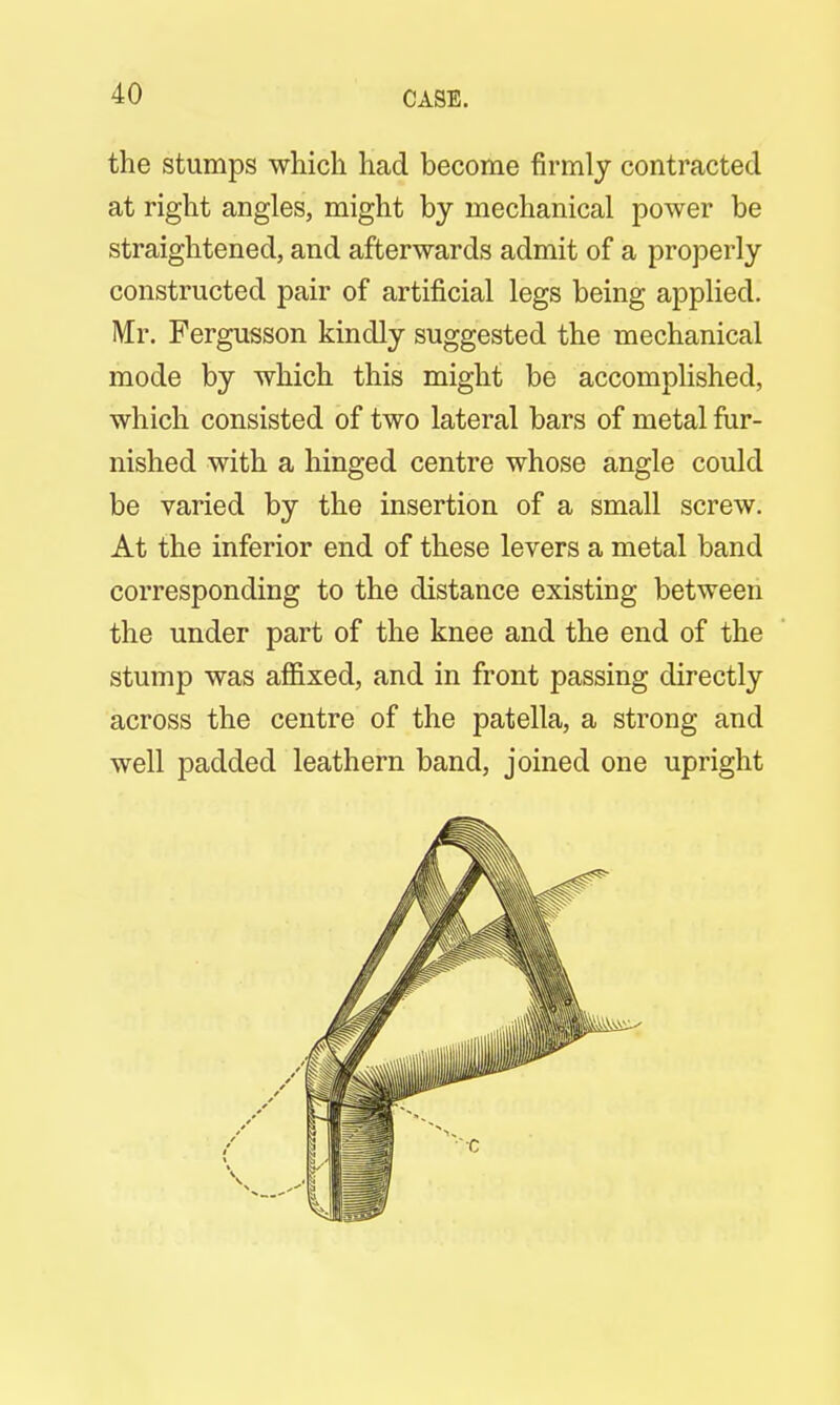 the stumps which had become firmly contracted at right angles, might by mechanical power be straightened, and afterwards admit of a properly constructed pair of artificial legs being applied. Mr. Fergusson kindly suggested the mechanical mode by which this might be accomplished, which consisted of two lateral bars of metal fur- nished with a hinged centre whose angle could be varied by the insertion of a small screw. At the inferior end of these levers a metal band corresponding to the distance existing between the under part of the knee and the end of the stump was affixed, and in front passing directly across the centre of the patella, a strong and well padded leathern band, joined one upright