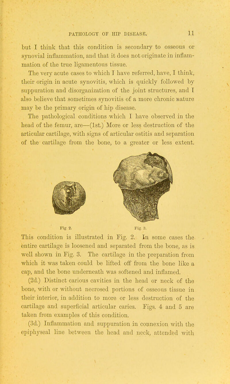 but I think that this condition is secondary to osseons or synovial inflammation, and that it does not originate in inflam- mation of the true ligamentous tissue. The very acute cases to which I have referred, have, I think, their origin in acute synovitis, which is qiiickly followed by suppuration and disorganization of the joint structures, and T also believe that sometimes synovitis of a more chronic nature may be the primary origin of hip disease. The pathological conditions which I have observed in the head of the femur, are—(1st.) More or less destruction of the articular cartilage, with signs of articular ostitis and separation of the cartilage from the bone, to a greater or less extent. Fig 2. Fig. 3. This condition is illustrated in Fig. 2. In some cases the entire cartilage is loosened and separated from the bone, as is well shown in Fig. 3. The cartilage in the preparation from which it was taken could be lifted off from the bone like a cap, and the bone underneath was softened and inflamed. (2d.) Distinct carious cavities in the head or neck of the bone, with or without necrosed portions of osseous tissue in their interior, in addition to more or less destruction of the cartilage and superficial articular caries. Figs. 4 and 5 are taken from examples of this condition. (3d.) Inflammation and suppuration in connexion with the epiphyseal line between the head and neck, attended with