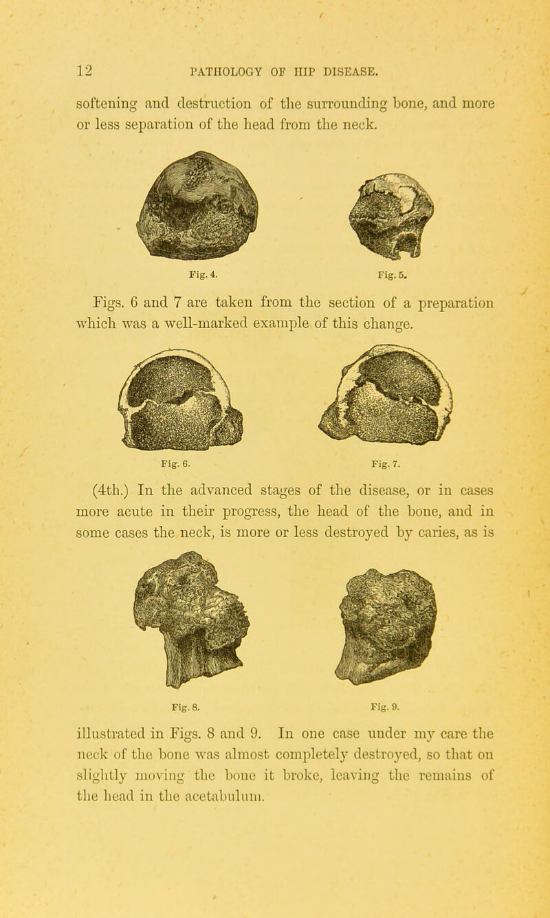 softening and destruction of the surrounding bone, and more or less separation of the head from the neck. Fig. 4. Fig. 5. Figs. 6 and 7 are taken from the section of a preparation which was a well-marked example of this change. Fig. 6. Fig. 7. (4th.) In the advanced stages of the disease, or in cases more acute in their progress, the head of the bone, and in some cases the neck, is more or less destroyed by caries, as is Fig. 8. Fig. 9. illustrated in Figs. 8 and 9. In one case under my care the neck of the bone was almost completely destroyed, so that on slightly moving the bone it broke, leaving the remains of the head in the acetabulum.