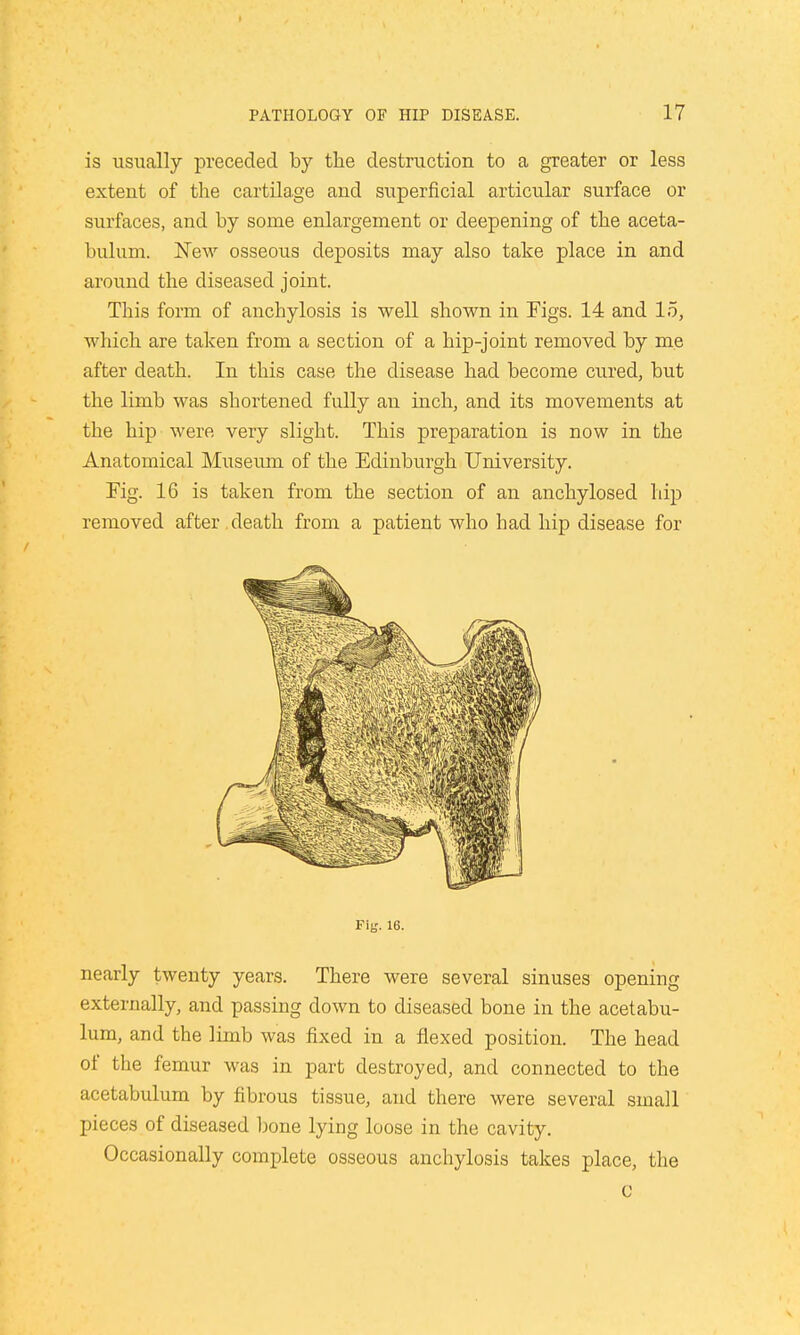 is usually preceded by the destruction to a greater or less extent of the cartilage and superficial articular surface or surfaces, and by some enlargement or deepening of the aceta- bulum. New osseous deposits may also take place in and around the diseased joint. This form of anchylosis is well shown in Figs. 14 and 15, which are taken from a section of a hip-joint removed by me after death. In this case the disease had become cured, but the limb was shortened fully an inch, and its movements at the hip were very slight. This preparation is now in the Anatomical Museum of the Edinburgh University. Fig. 16 is taken from the section of an anchylosed hip removed after death from a patient who had hip disease for Fig. 16. nearly twenty years. There were several sinuses opening externally, and passing down to diseased bone in the acetabu- lum, and the limb was fixed in a flexed position. The head of the femur was in part destroyed, and connected to the acetabulum by fibrous tissue, and there were several small pieces of diseased bone lying loose in the cavity. Occasionally complete osseous anchylosis takes place, the c