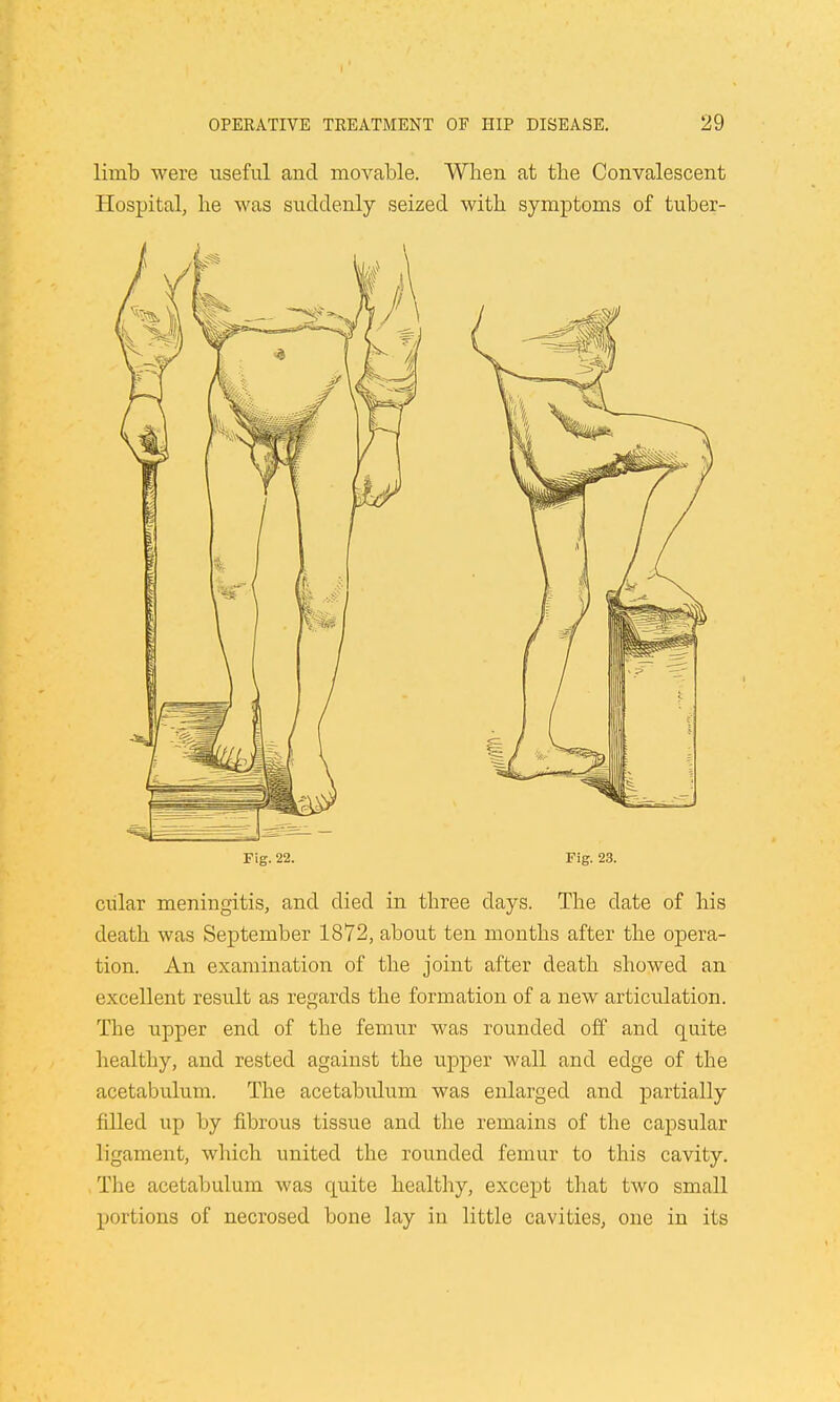 limb were useful and movable. When at tbe Convalescent Hospital, lie was suddenly seized witb symptoms of tuber- Fig. 22. Fig. 23. cular meningitis, and died in three days. Tbe date of bis death was September 1872, about ten months after the opera- tion. An examination of the joint after death showed an excellent result as regards the formation of a new articulation. The upper end of the femur was rounded off and quite healthy, and rested against the upper wall and edge of the acetabulum. The acetabulum was enlarged and partially filled up by fibrous tissue and the remains of the capsular ligament, which united the rounded femur to this cavity. The acetabulum was quite healthy, except that two small portions of necrosed bone lay in little cavities, one in its