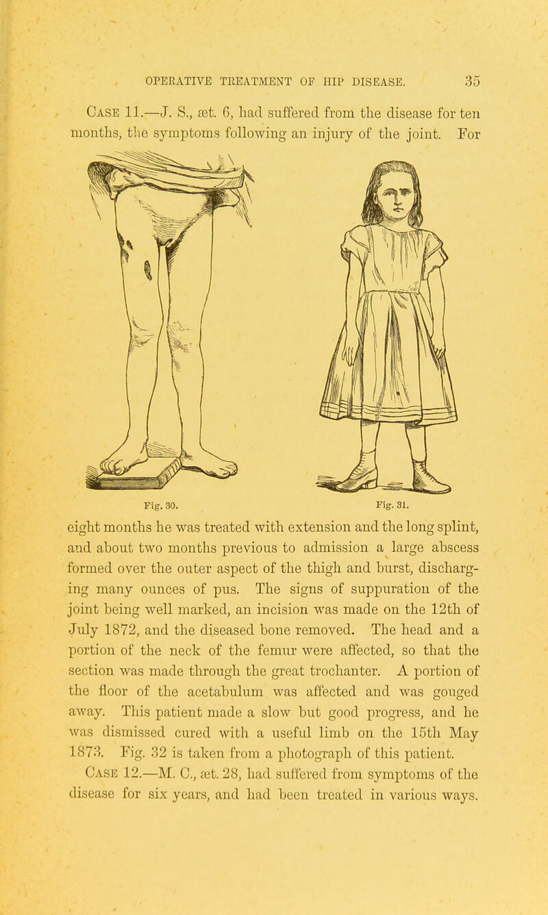 Case 11.—J. S., set. 6, had suffered from the disease for ten months, the symptoms following an injury of the joint. For Fig. 30. Fig. 31. eight months he was treated with extension and the long splint, and ahout two months previous to admission a large abscess formed over the outer aspect of the thigh and burst, discharg- ing many ounces of pus. The signs of suppuration of the joint being well marked, an incision was made on the 12th of July 1872, and the diseased bone removed. The head and a portion of the neck of the femur were affected, so that the section was made through the great trochanter. A portion of the floor of the acetabulum was affected and was gouged away. This patient made a slow but good progress, and he was dismissed cured with a useful limb on the 15th May 1873. Fig. 32 is taken from a photograph of this patient. Case 12—M. C, £et.28, had suffered from symptoms of the disease for six years, and had been treated in various ways.