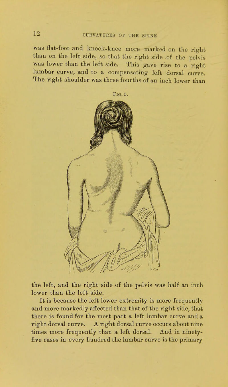 was flat-foot and knock-knee more marked on the right than on the left side, so that the right side of the pelvis was lower than the left side. This gave rise to a right lumbar curve, and to a compensating left dorsal curve. The right shoulder was three fourths of an inch lower than Fig. 5. the left, and the right side of the pelvis was half an inch lower than the left side. It is because the left lower extremity is more frequently and more markedly affected than that of the right side, that there is found for the most part a left lumbar curve and a right dorsal curve. A right dorsal curve occurs about nine times more frequently than a left dorsal. And in ninety- five cases in every hundred the lumbar curve is the primary