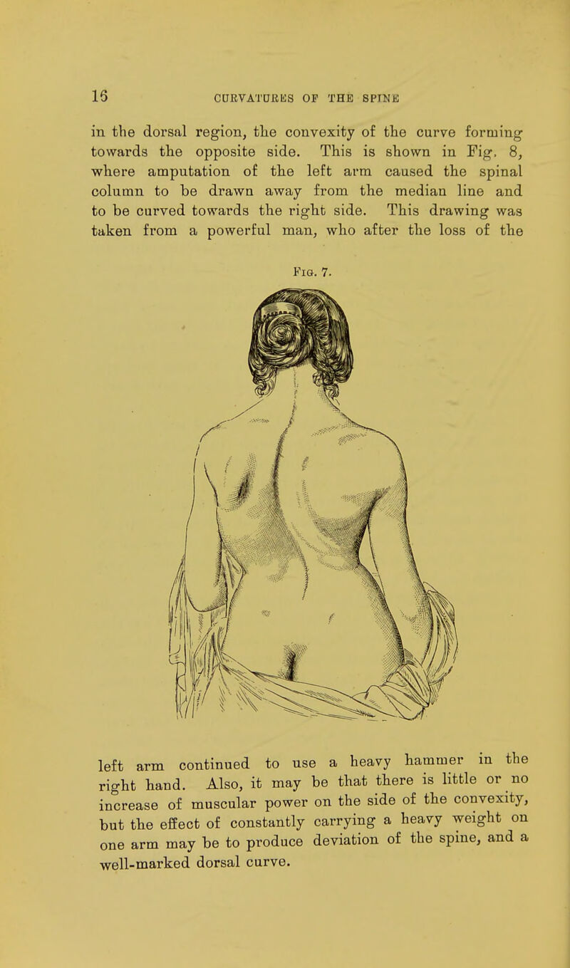 15 in the dorsal region, the convexity of the curve forming towards the opposite side. This is shown in Fig, 8, where amputation of the left arm caused the spinal column to be drawn away from the median line and to be curved towards the right side. This drawing was taken from a powerful man, who after the loss of the Fig. 7. left arm continued to use a heavy hammer in the right haud. Also, it may be that there is little or no increase of muscular power on the side of the convexity, but the effect of constantly carrying a heavy weight on one arm may be to produce deviation of the spine, and a well-marked dorsal curve.