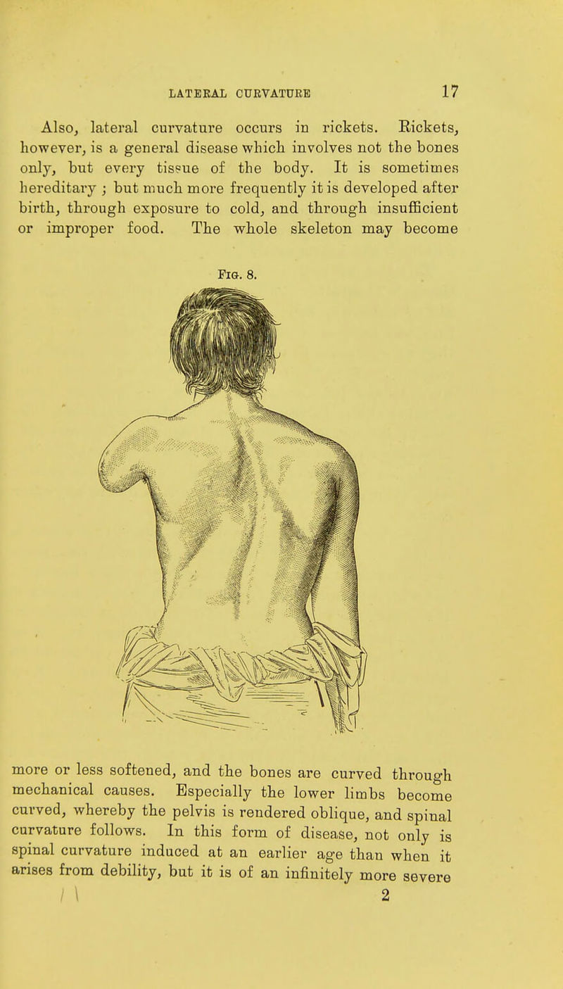 Also, lateral curvature occurs in rickets. Rickets, however, is a general disease which involves not the bones only, but every tis?ue of the body. It is sometimes hereditary ; but much more frequently it is developed after birth, through exposure to cold, and through insufficient or improper food. The whole skeleton may become Fig. 8. more or less softened, and the bones are curved through mechanical causes. Especially the lower limbs become curved, whereby the pelvis is rendered oblique, and spinal curvature follows. In this form of disease, not only is spinal curvature induced at an earlier age than when it arises from debility, but it is of an infinitely more severe / \ 2